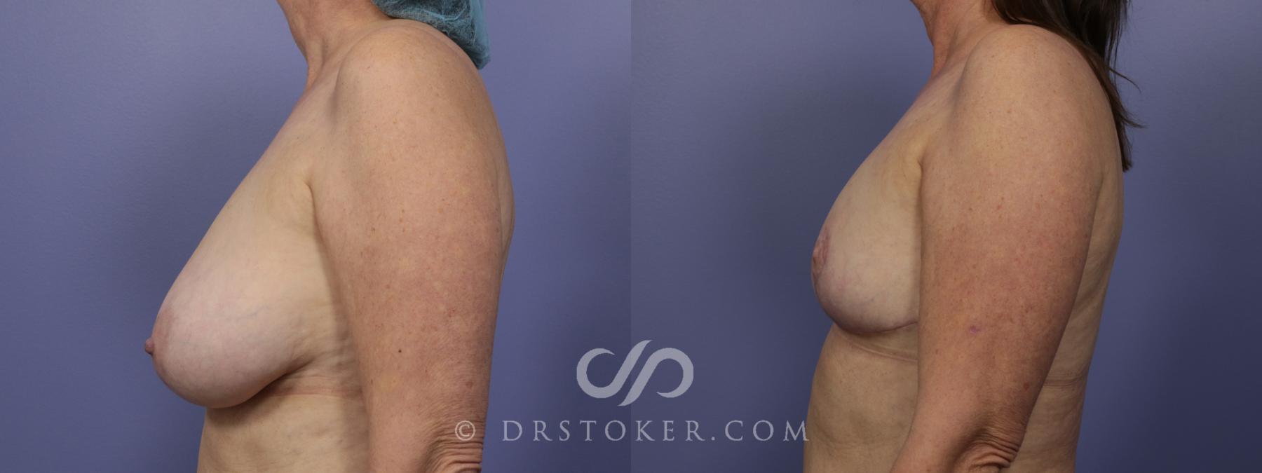 Before & After Breast Reduction (for Women) Case 882 View #4 View in Los Angeles, CA