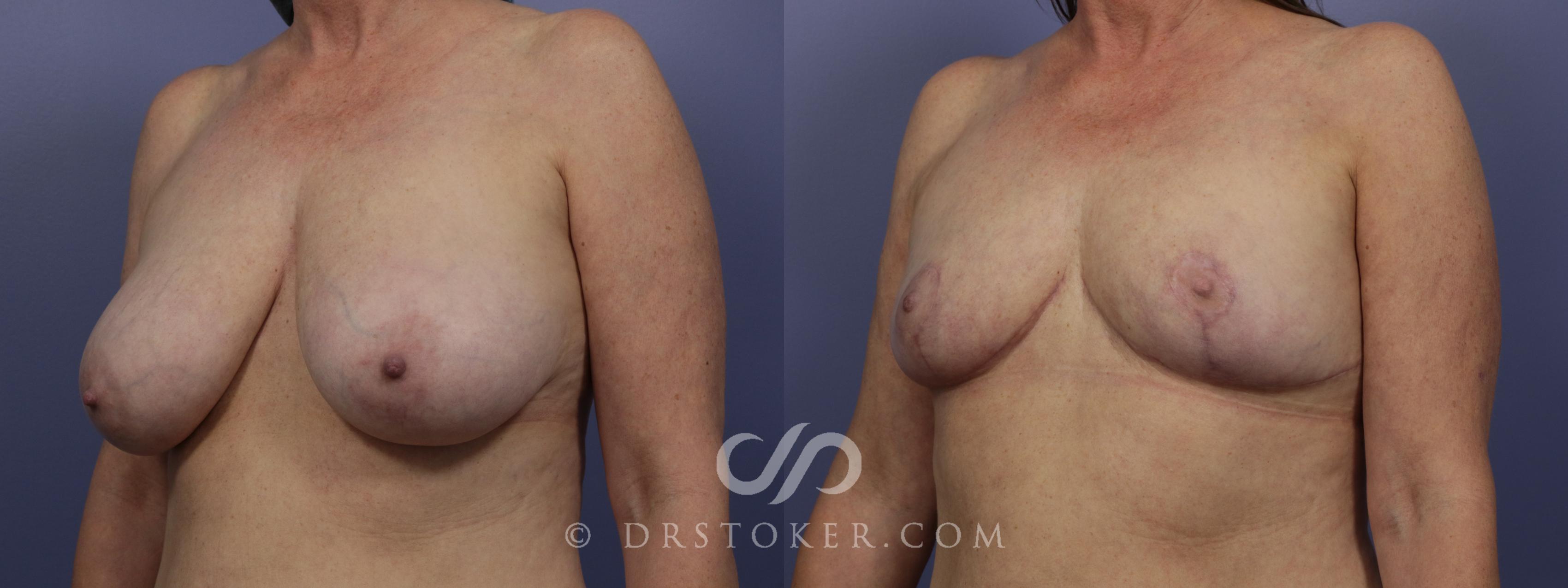 Before & After Breast Reduction (for Women) Case 882 View #5 View in Los Angeles, CA