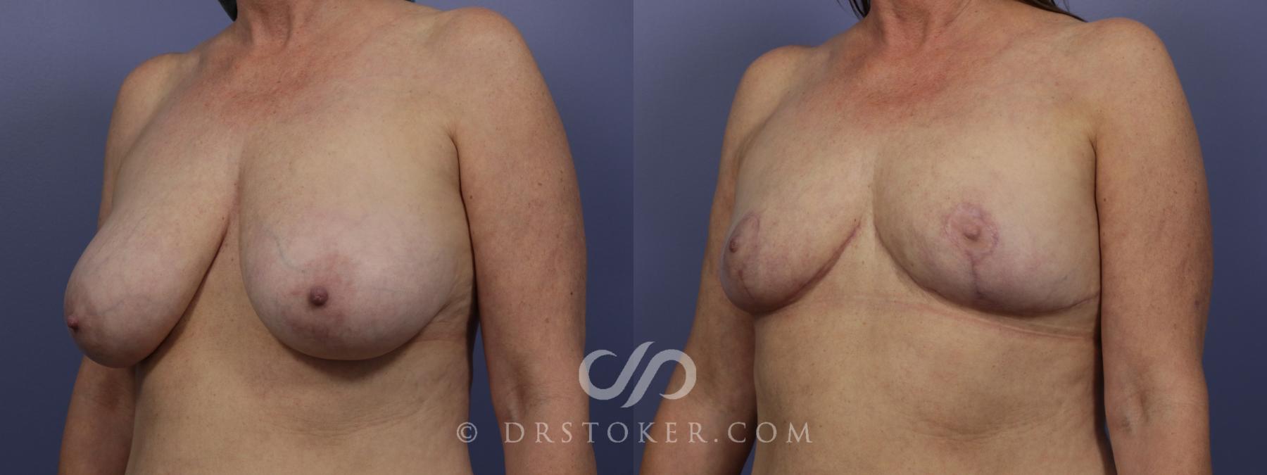 Before & After Breast Reduction (for Women) Case 882 View #5 View in Los Angeles, CA