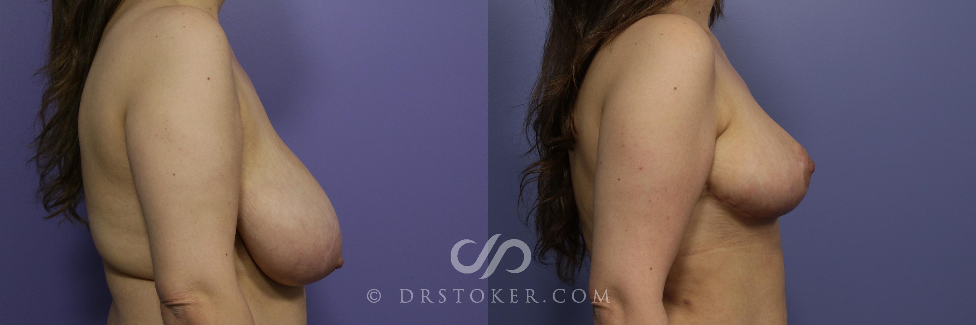Before & After Breast Reduction (for Women) Case 883 View #3 View in Los Angeles, CA