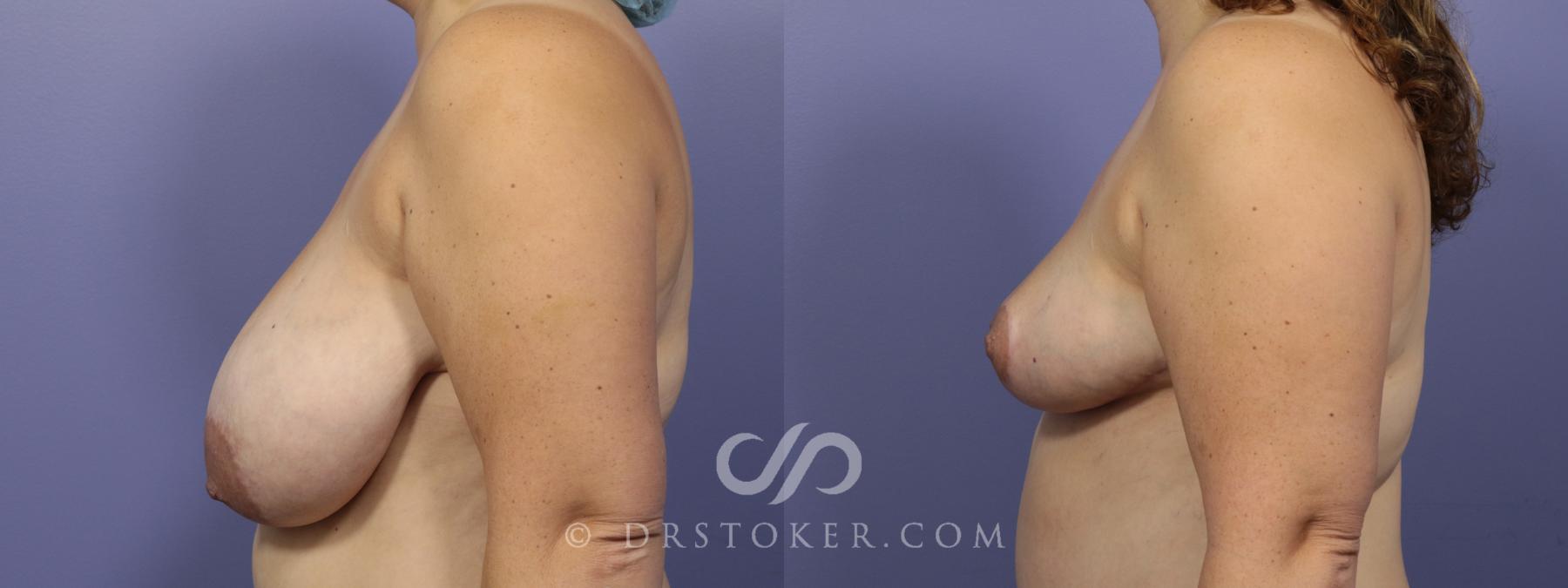Before & After Breast Reduction (for Women) Case 884 View #3 View in Los Angeles, CA