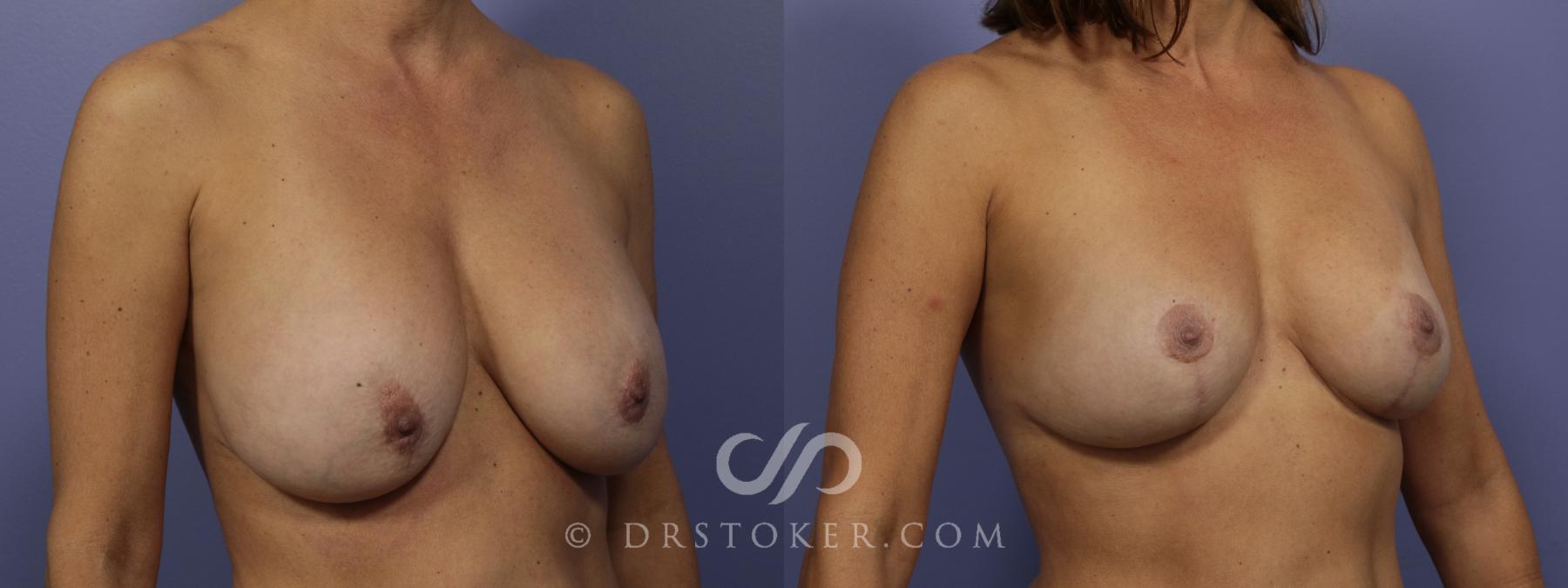 Before & After Breast Reduction (for Women) Case 885 View #2 View in Los Angeles, CA