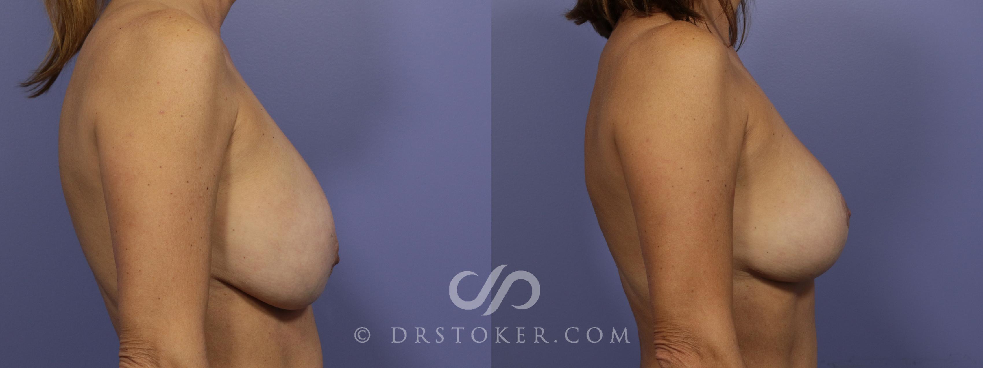 Before & After Breast Reduction (for Women) Case 885 View #3 View in Los Angeles, CA