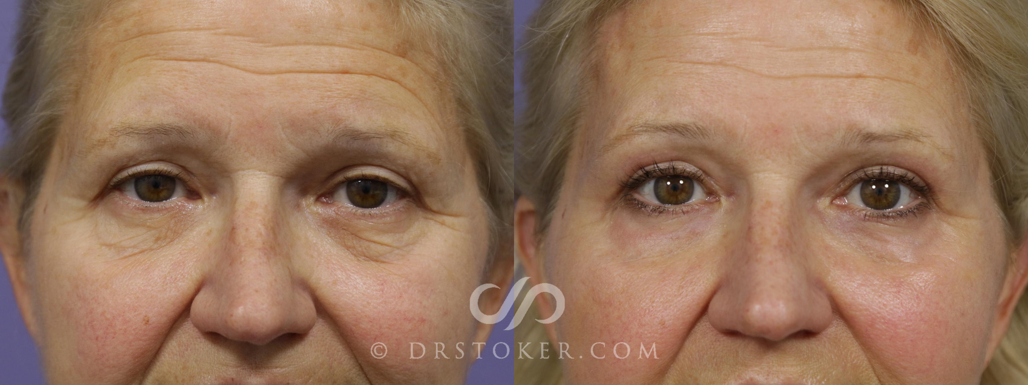 Before & After Brow Lift Case 1494 View #1 View in Marina del Rey, CA