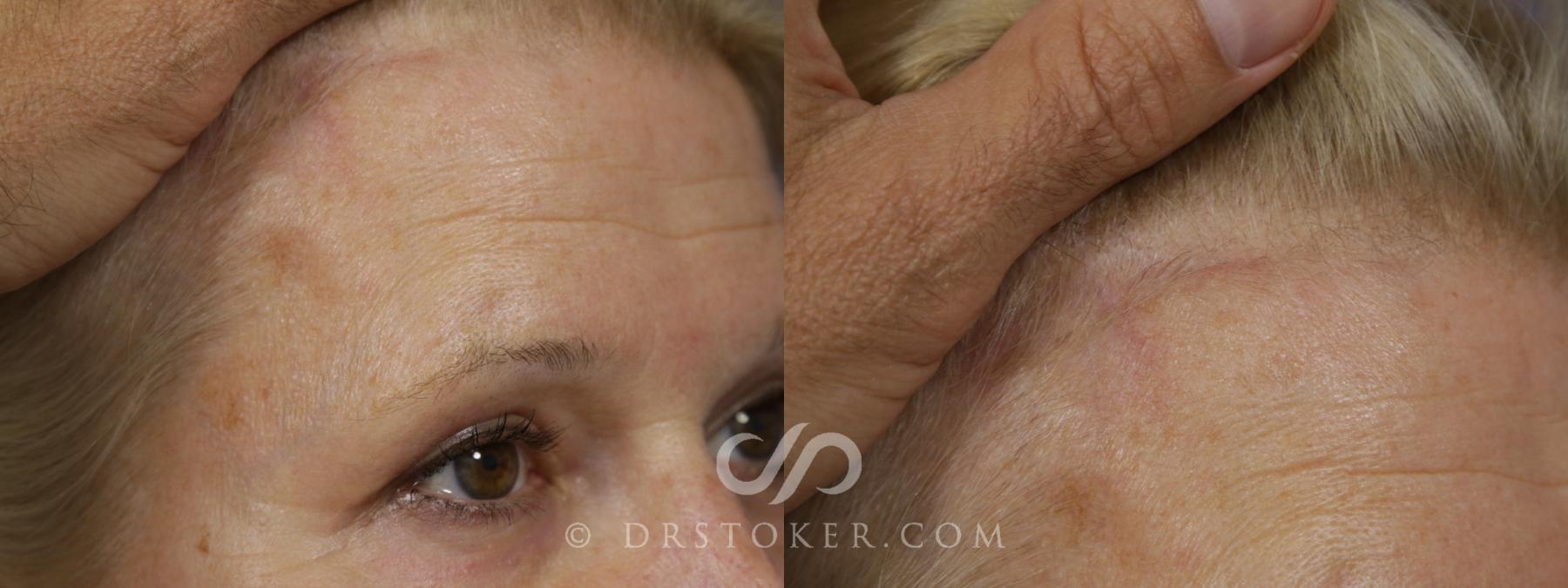Before & After Brow Lift Case 1494 View #2 View in Los Angeles, CA