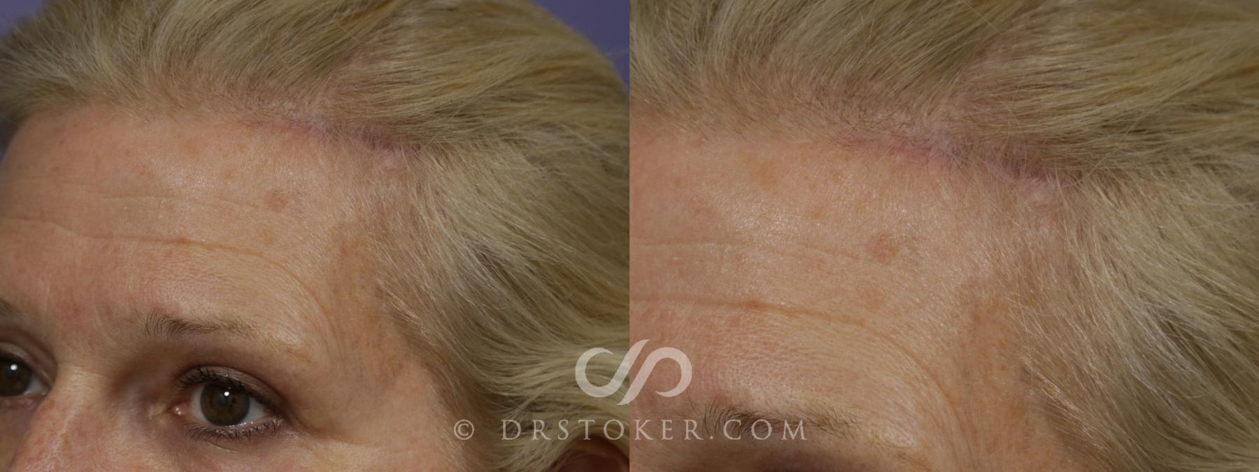 Before & After Brow Lift Case 1494 View #3 View in Los Angeles, CA