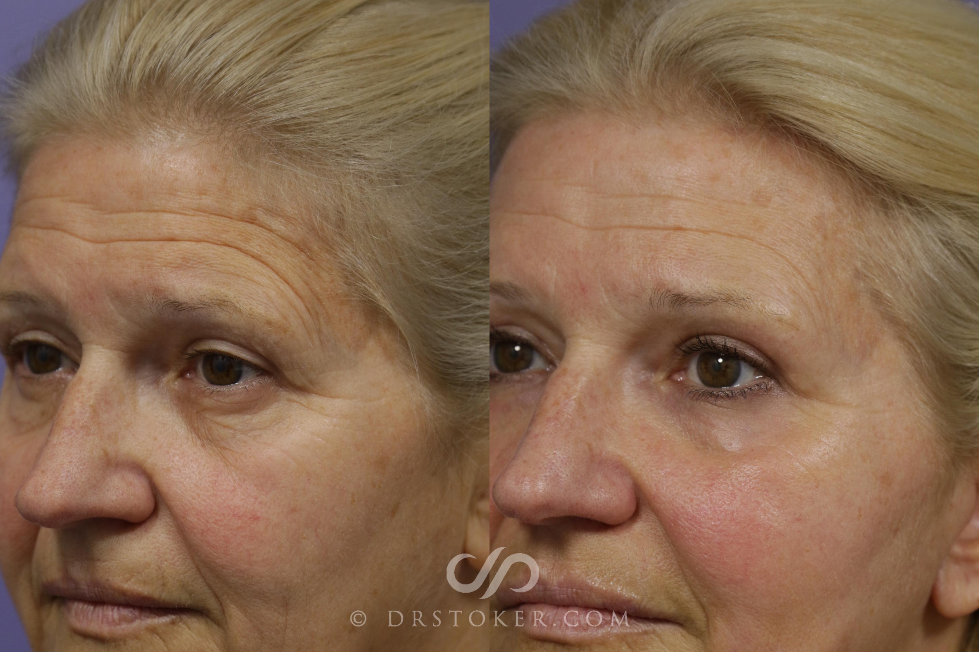 Before & After Brow Lift Case 1495 View #1 View in Marina del Rey, CA