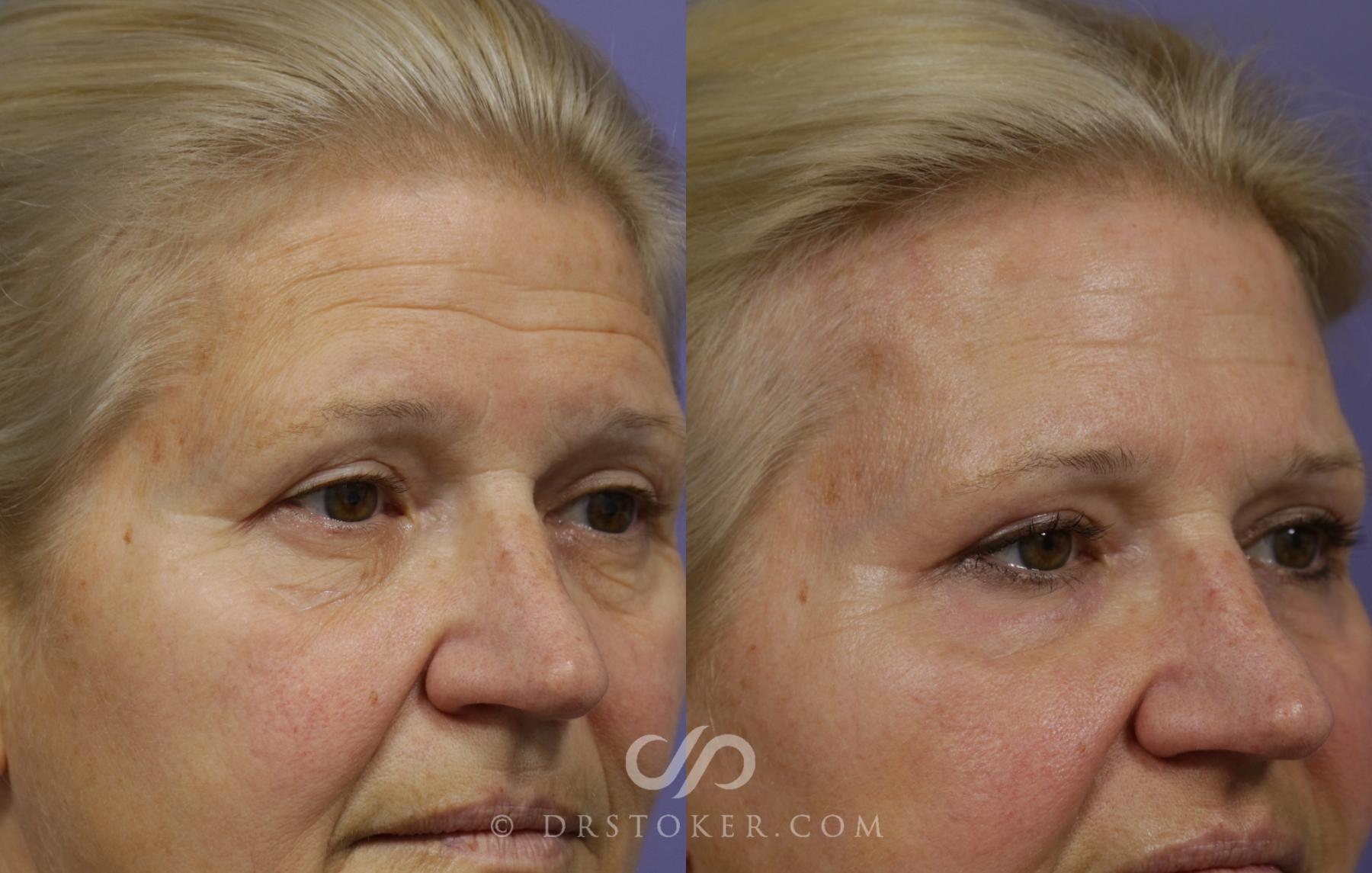 Before & After Brow Lift Case 1495 View #2 View in Los Angeles, CA