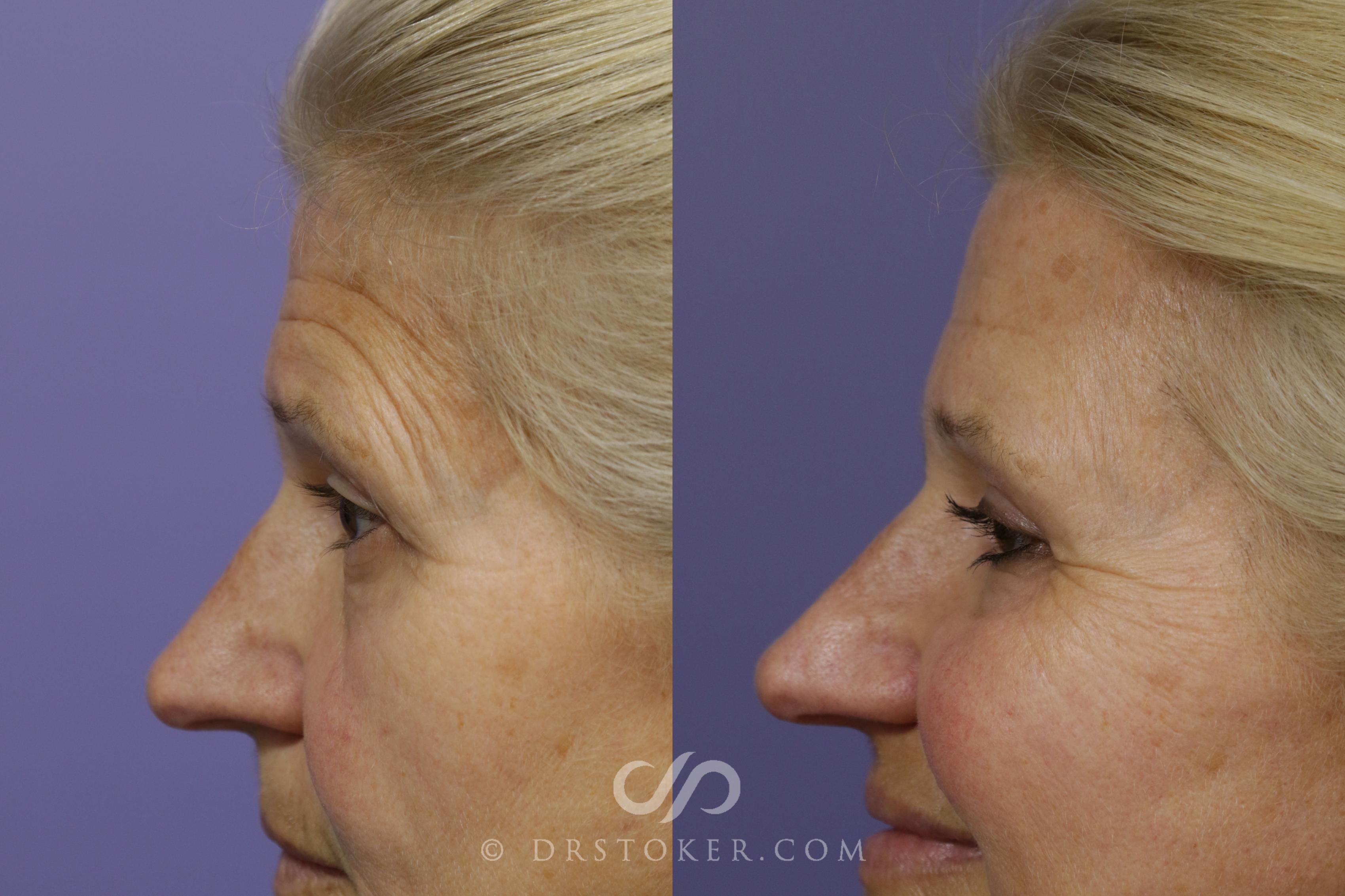 Before & After Brow Lift Case 1496 View #1 View in Marina del Rey, CA
