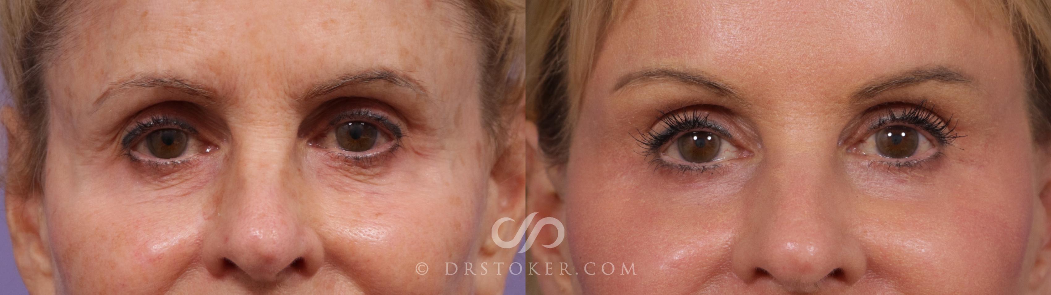 Before & After Brow Lift Case 2295 Front View in Los Angeles, CA