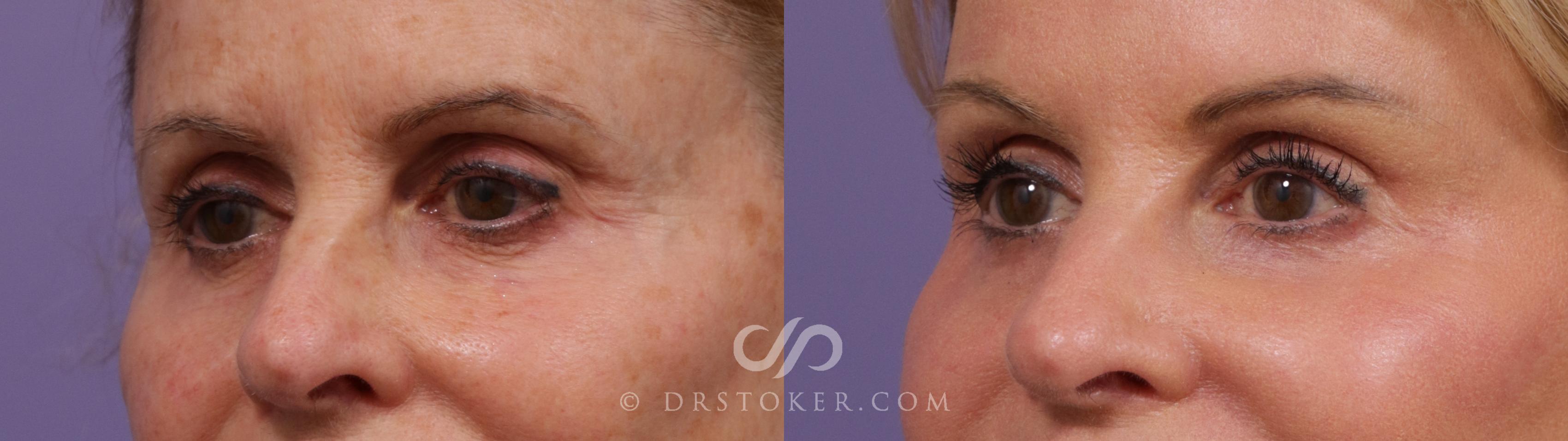 Before & After Brow Lift Case 2296 Left Oblique View in Los Angeles, CA