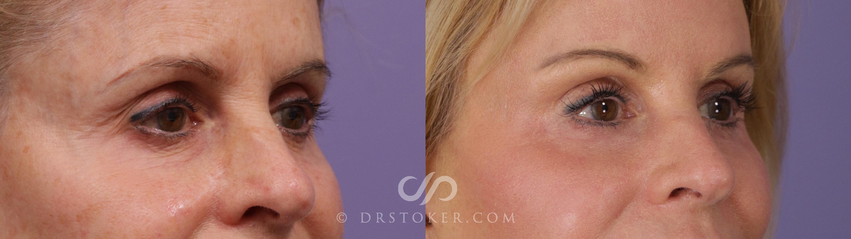 Before & After Brow Lift Case 2297 Right Oblique View in Los Angeles, CA