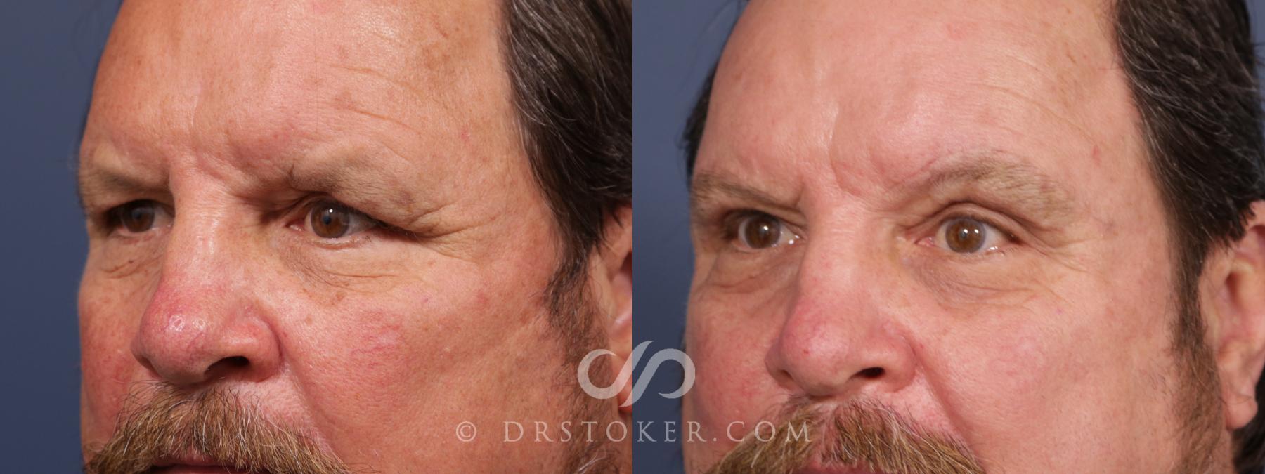 Before & After Brow Lift Case 2661 Left Oblique View in Los Angeles, CA