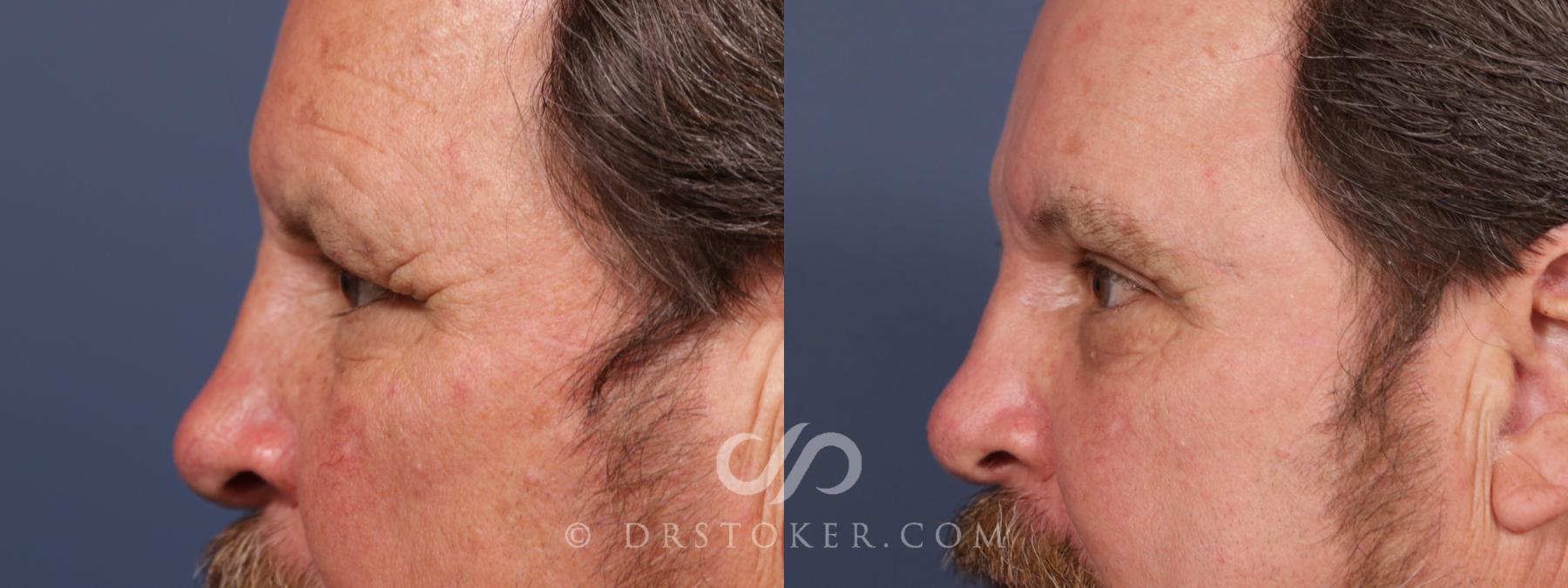 Before & After Brow Lift Case 2661 Left Side View in Los Angeles, CA