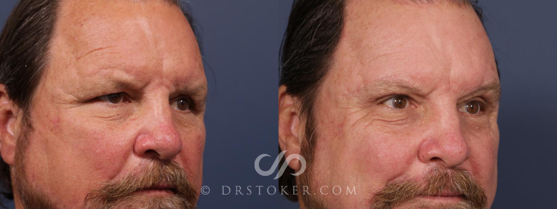 Before & After Brow Lift Case 2661 Right Oblique View in Los Angeles, CA