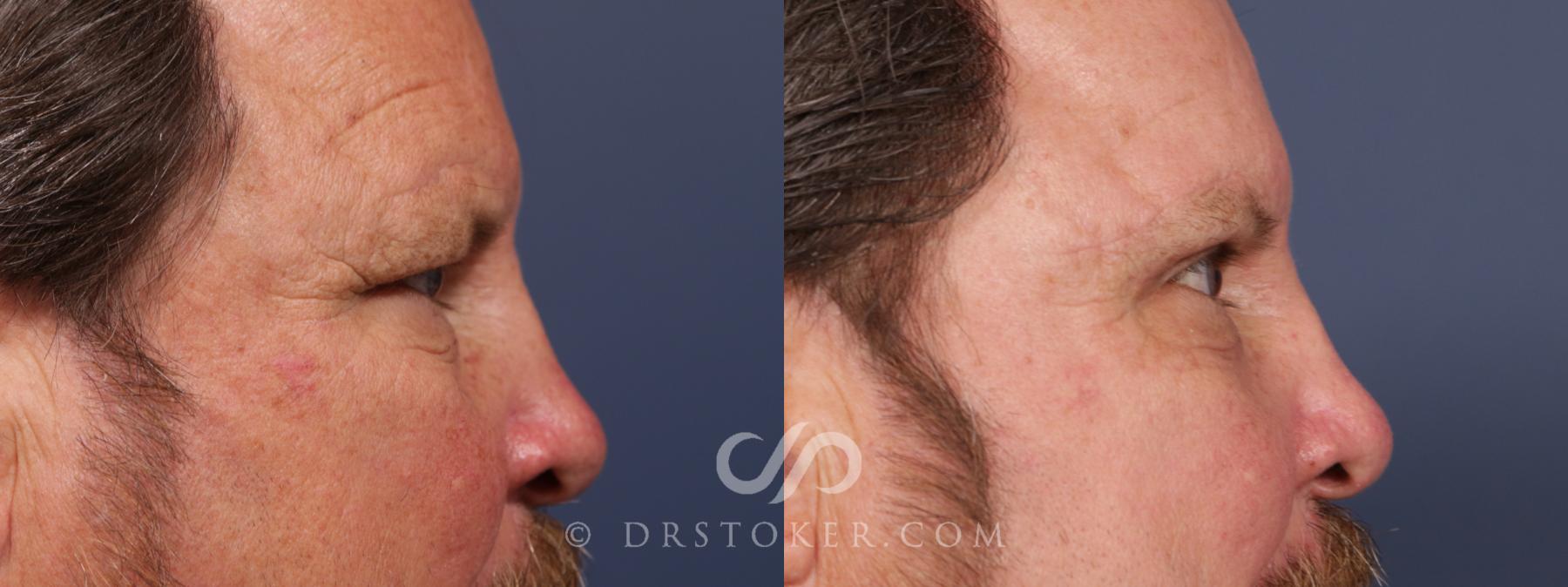 Before & After Brow Lift Case 2661 Right Side View in Los Angeles, CA
