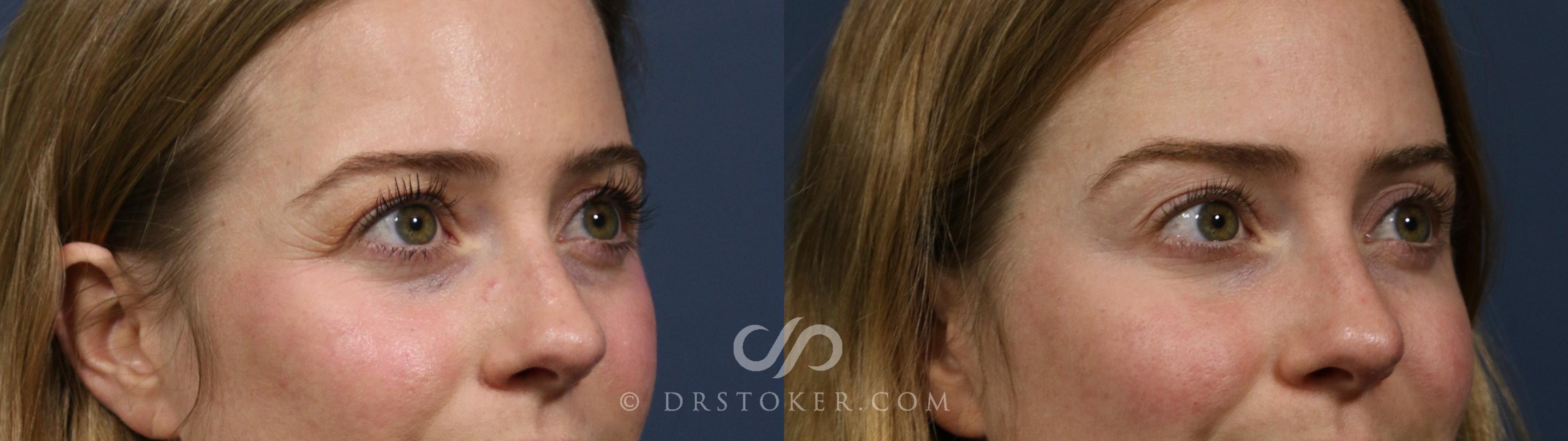 Before & After Brow Lift (Non-surgical) Case 2284 Right Oblique View in Los Angeles, CA