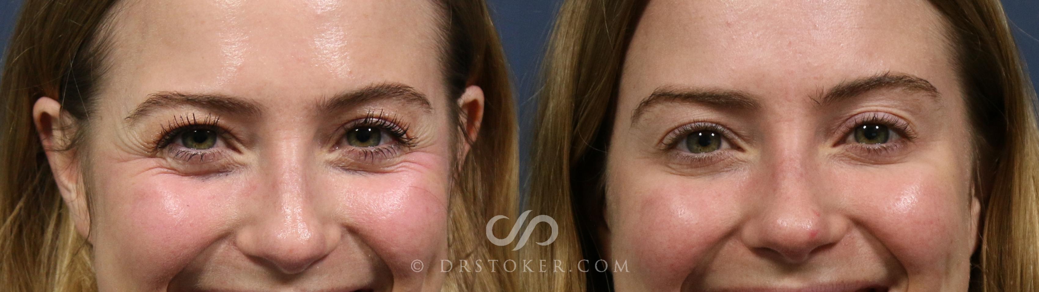 Before & After Brow Lift (Non-surgical) Case 2285 Front View in Los Angeles, CA