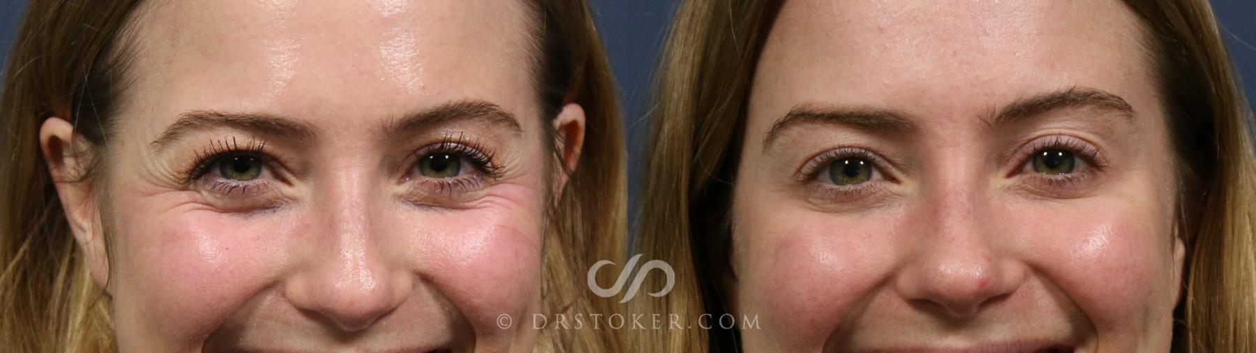 Before & After Brow Lift (Non-surgical) Case 2285 Front View in Los Angeles, CA