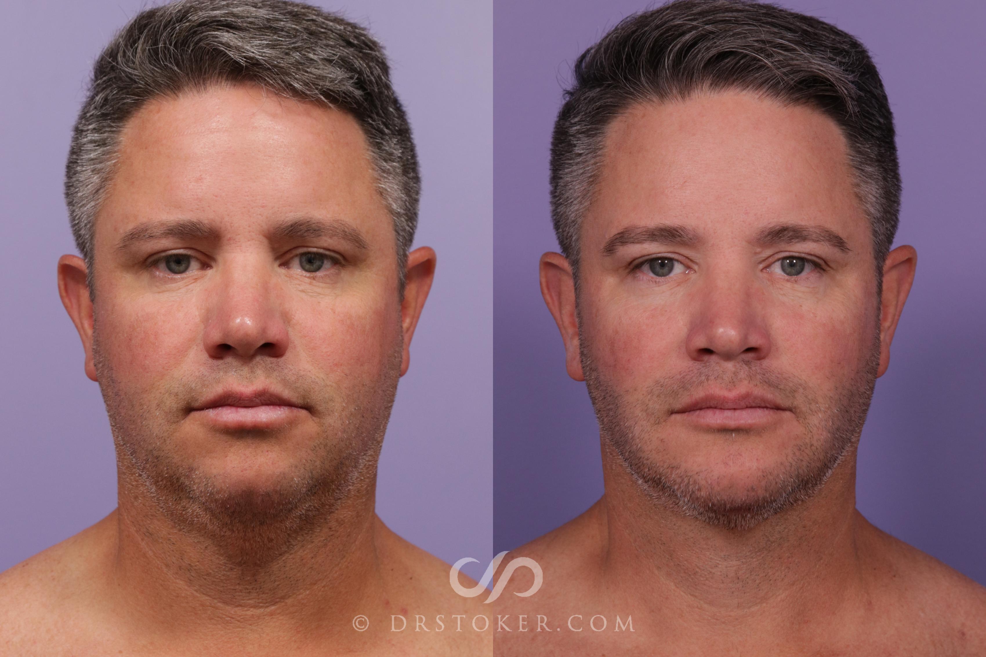 Before & After Chin Augmentation Case 1742 View #1 View in Marina del Rey, CA