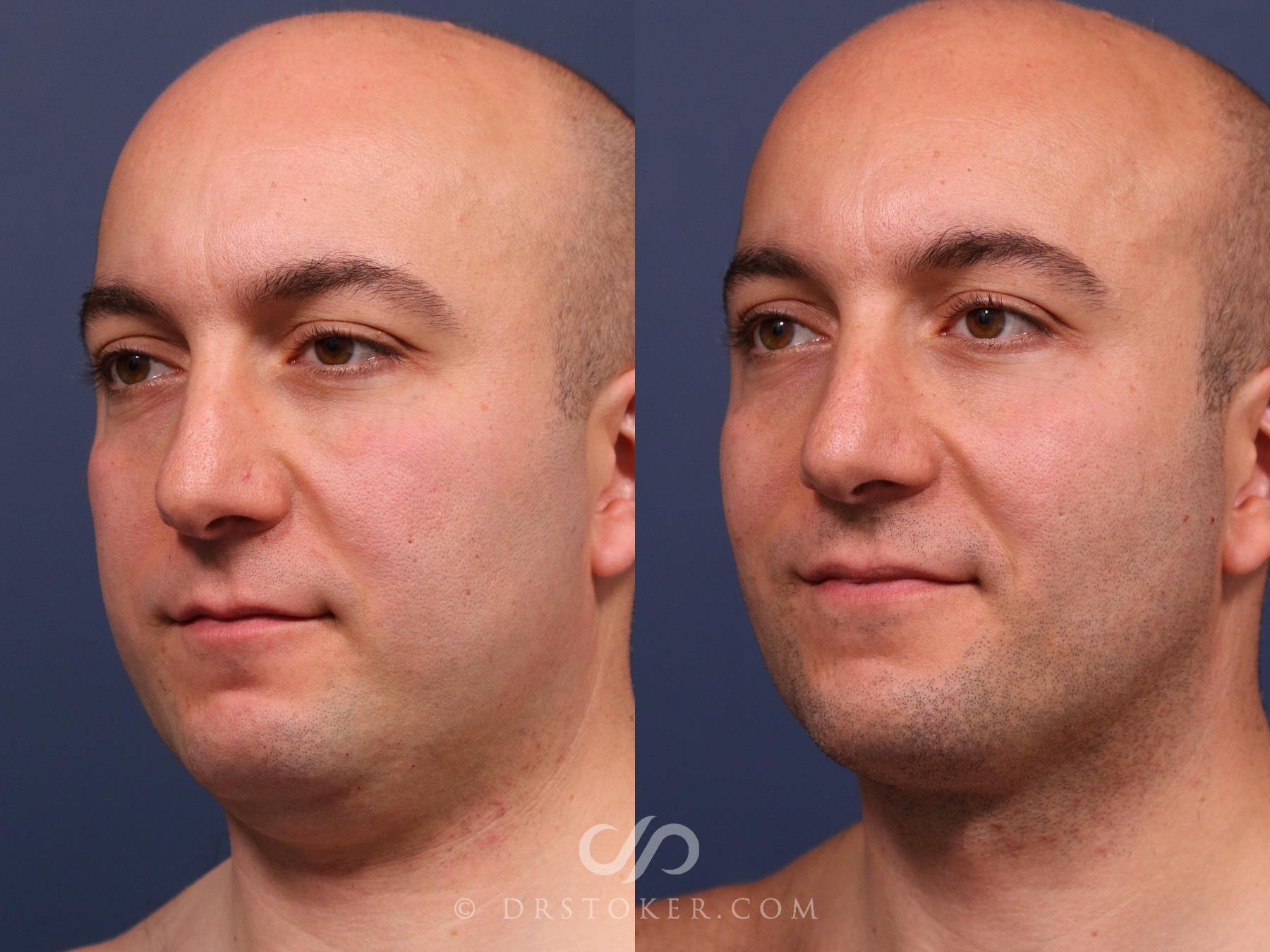 Before & After Buccal Fat Reduction Case 2319 Left Oblique View in Los Angeles, CA