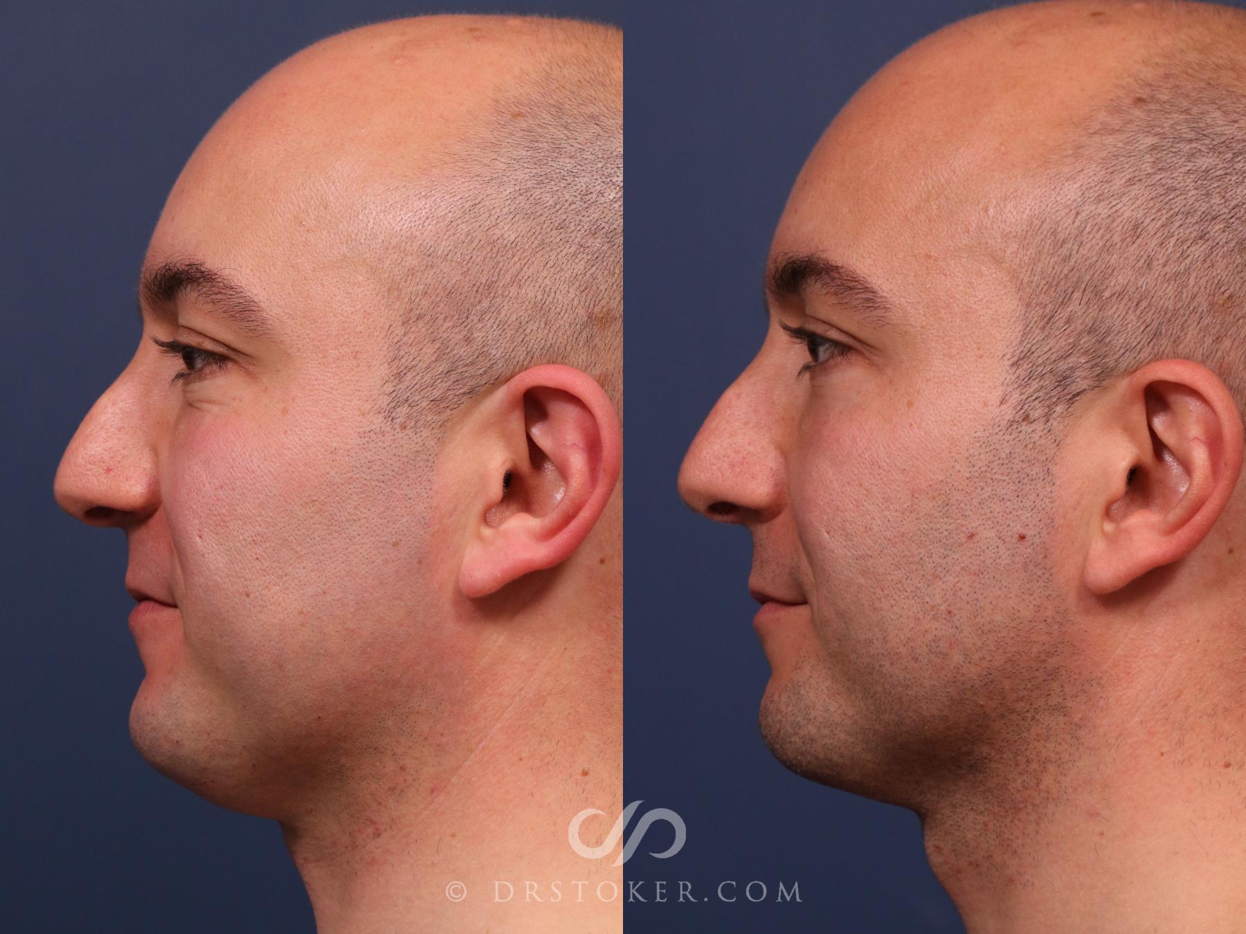 Before & After Buccal Fat Reduction Case 2319 Left Side View in Los Angeles, CA