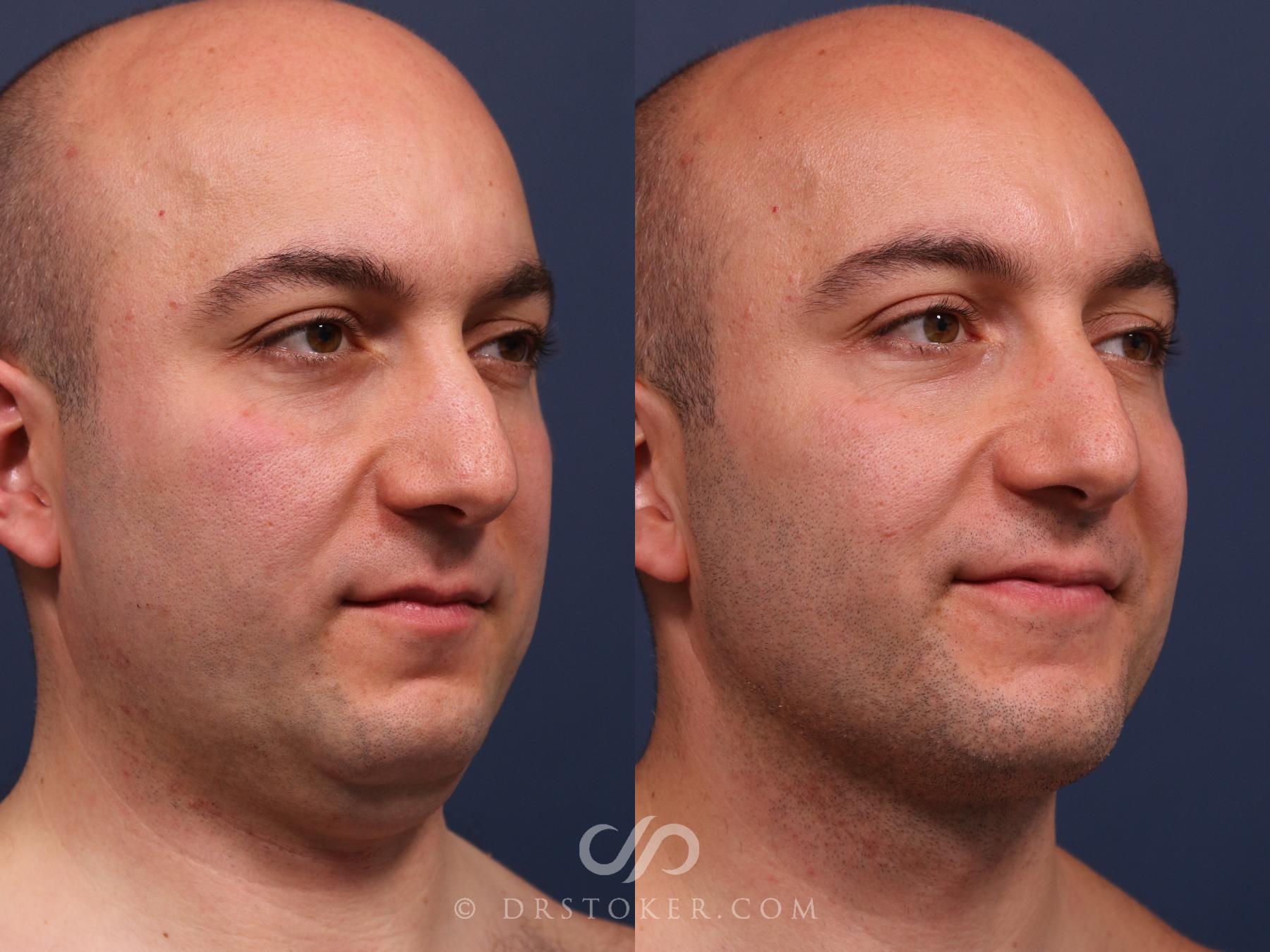 Before & After Buccal Fat Reduction Case 2319 Right Oblique View in Los Angeles, CA