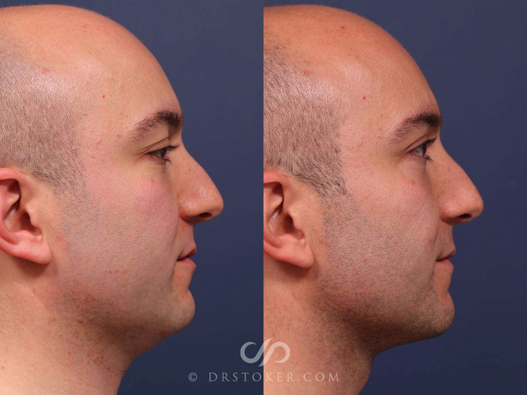 Before & After Buccal Fat Reduction Case 2319 Right Side View in Los Angeles, CA