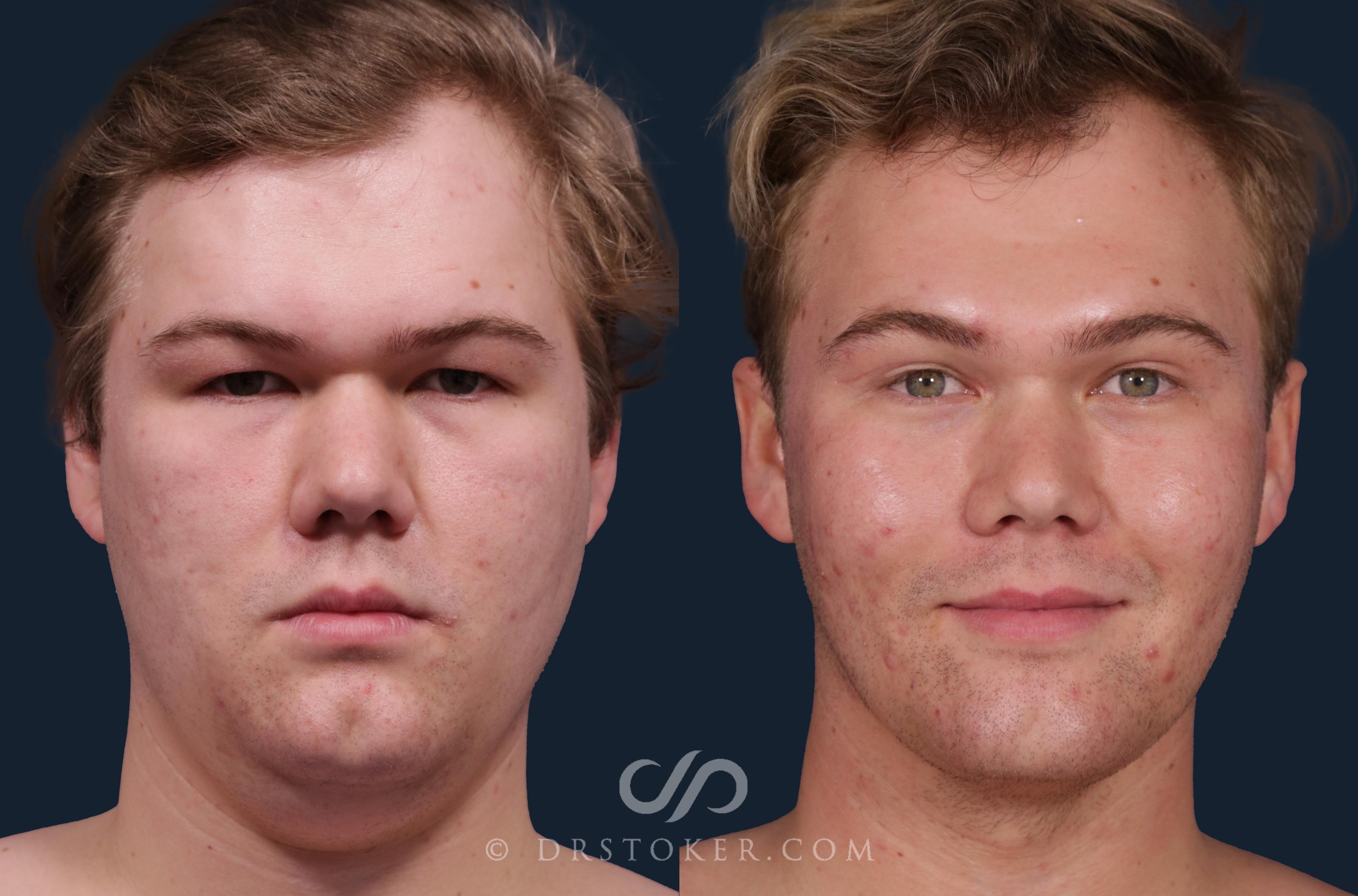 Before & After Buccal Fat Reduction Case 2324 Front View in Los Angeles, CA