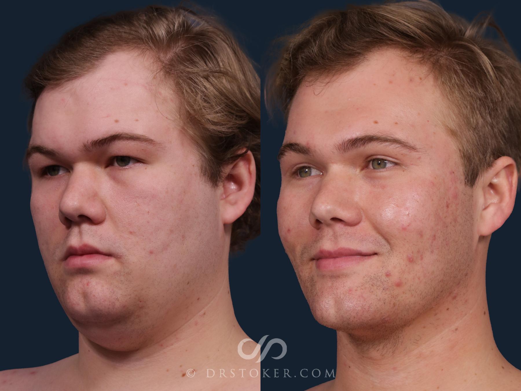 Before & After Buccal Fat Reduction Case 2324 Left Oblique View in Los Angeles, CA