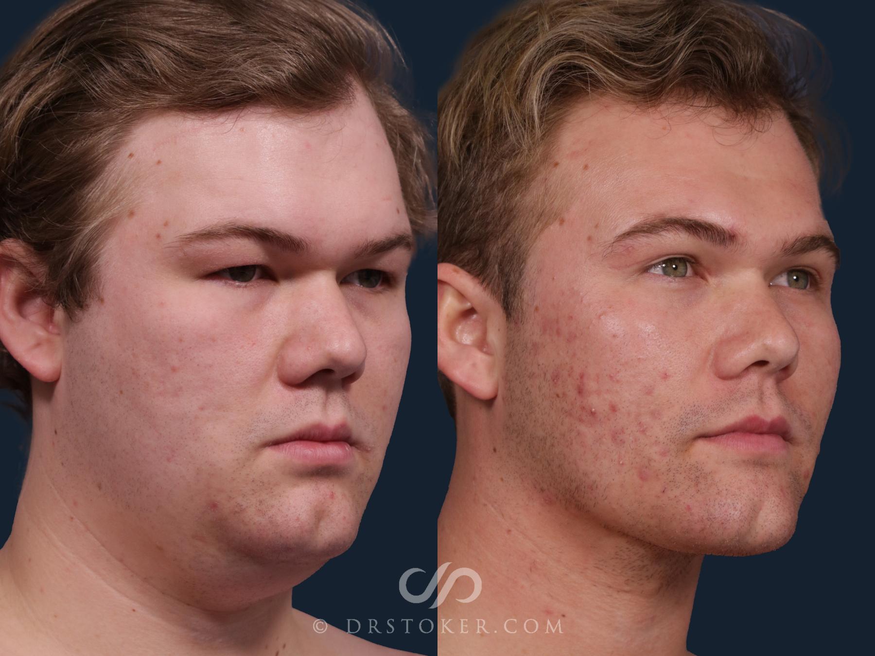 Before & After Buccal Fat Reduction Case 2324 Right Oblique View in Los Angeles, CA