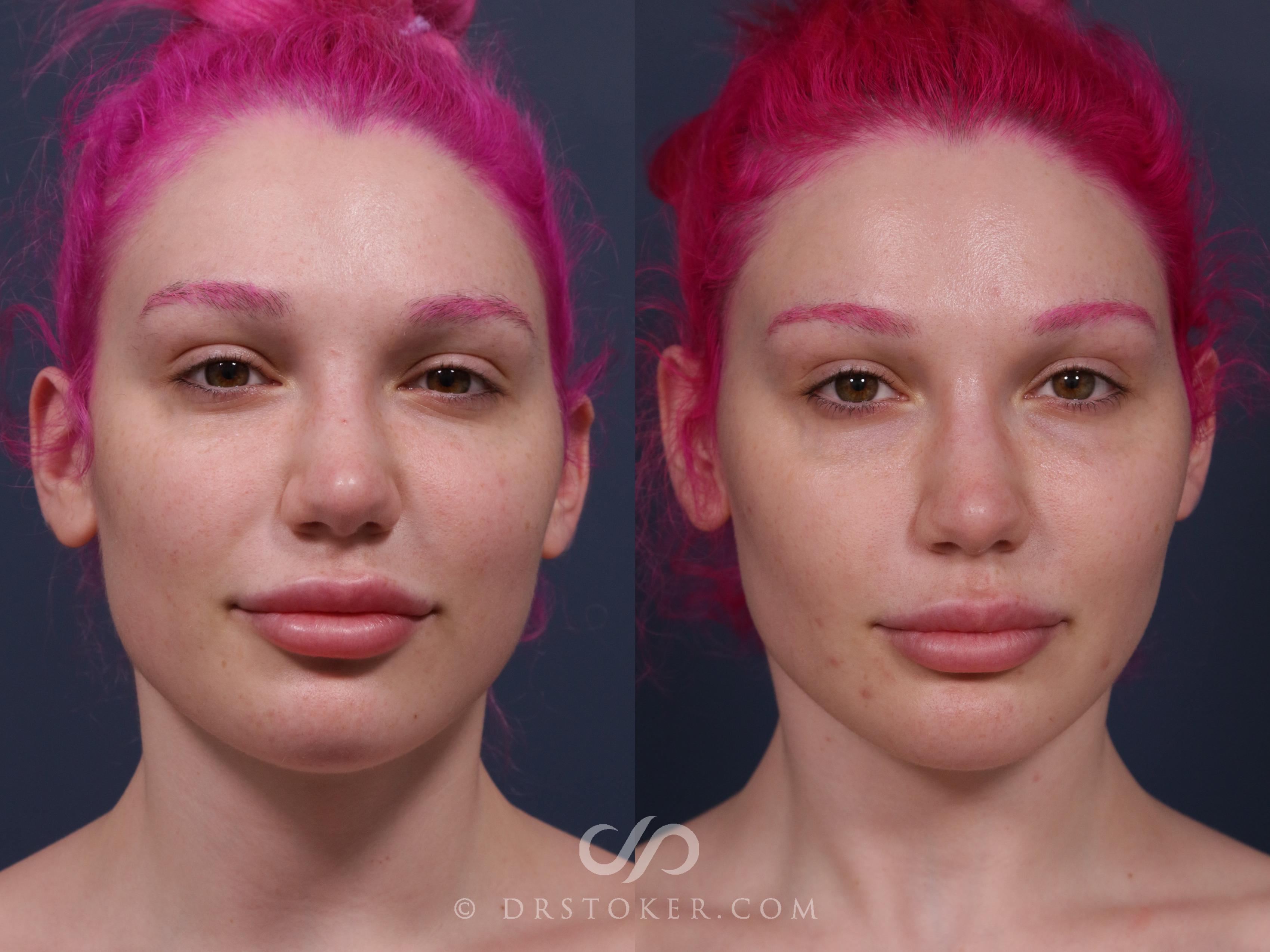 Before & After Buccal Fat Reduction Case 2325 Front View in Los Angeles, CA