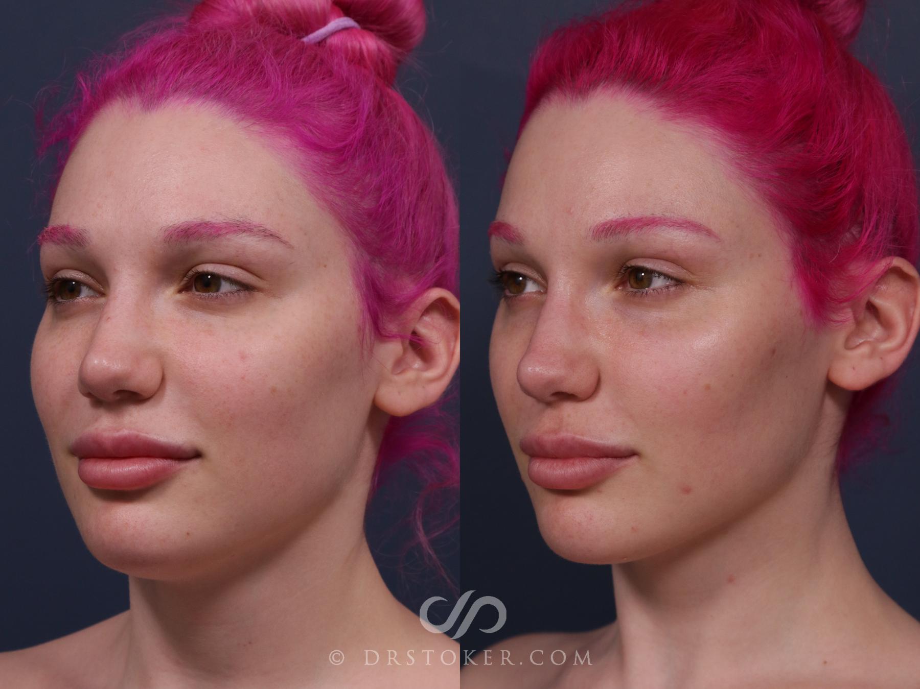 Before & After Buccal Fat Reduction Case 2325 Left Oblique View in Los Angeles, CA