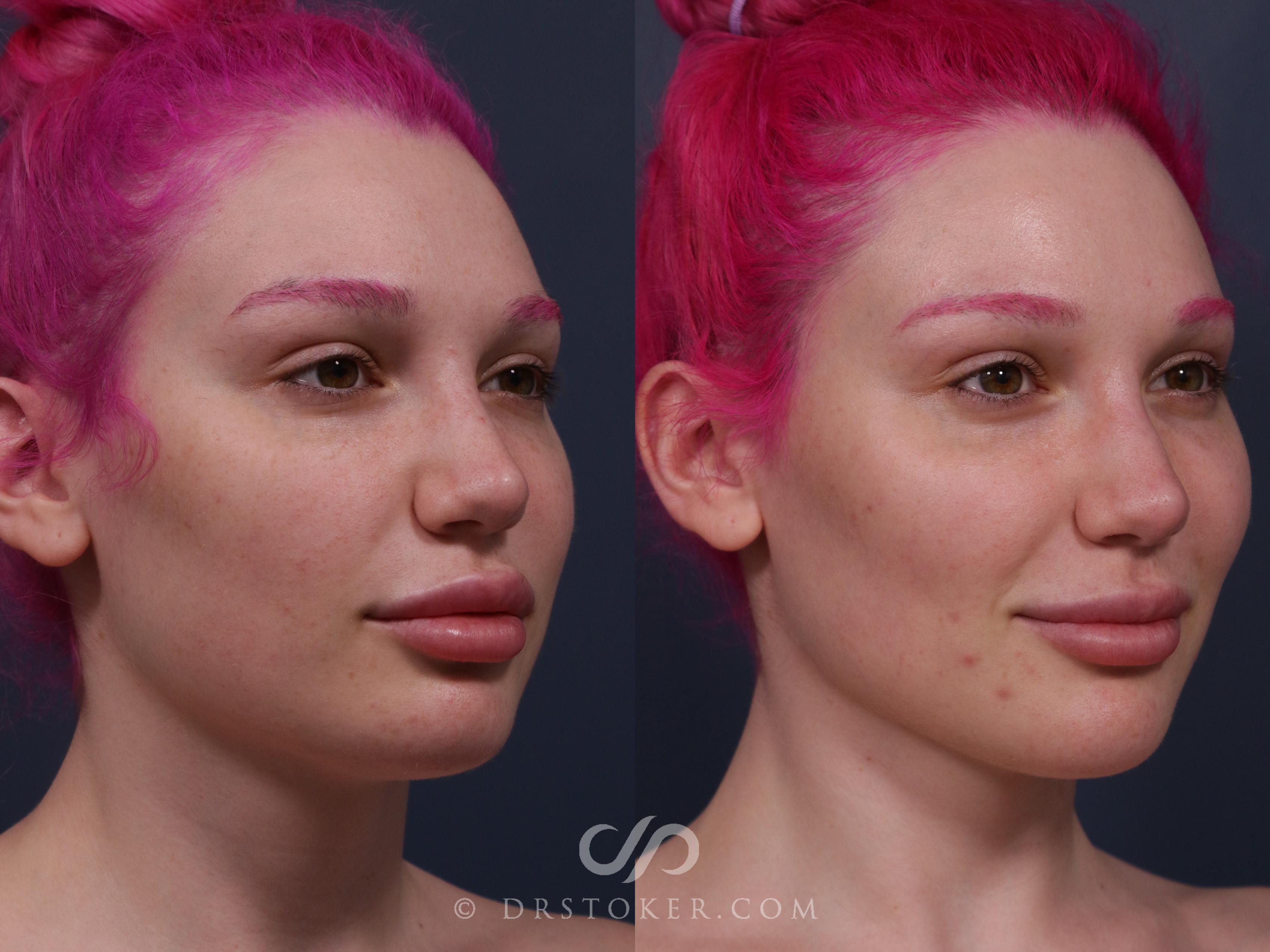 Before & After Buccal Fat Reduction Case 2325 Right Oblique View in Los Angeles, CA