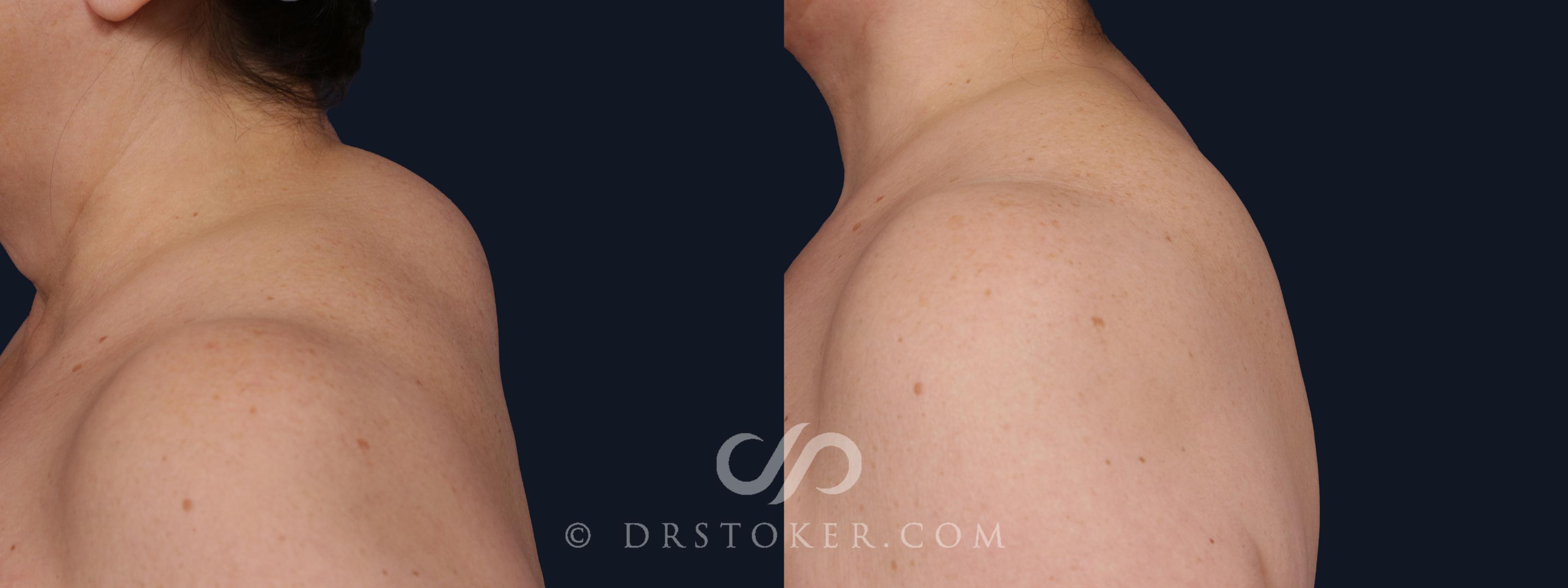 Before & After Buffalo Hump Removal  Case 2066 Left Side View in Los Angeles, CA
