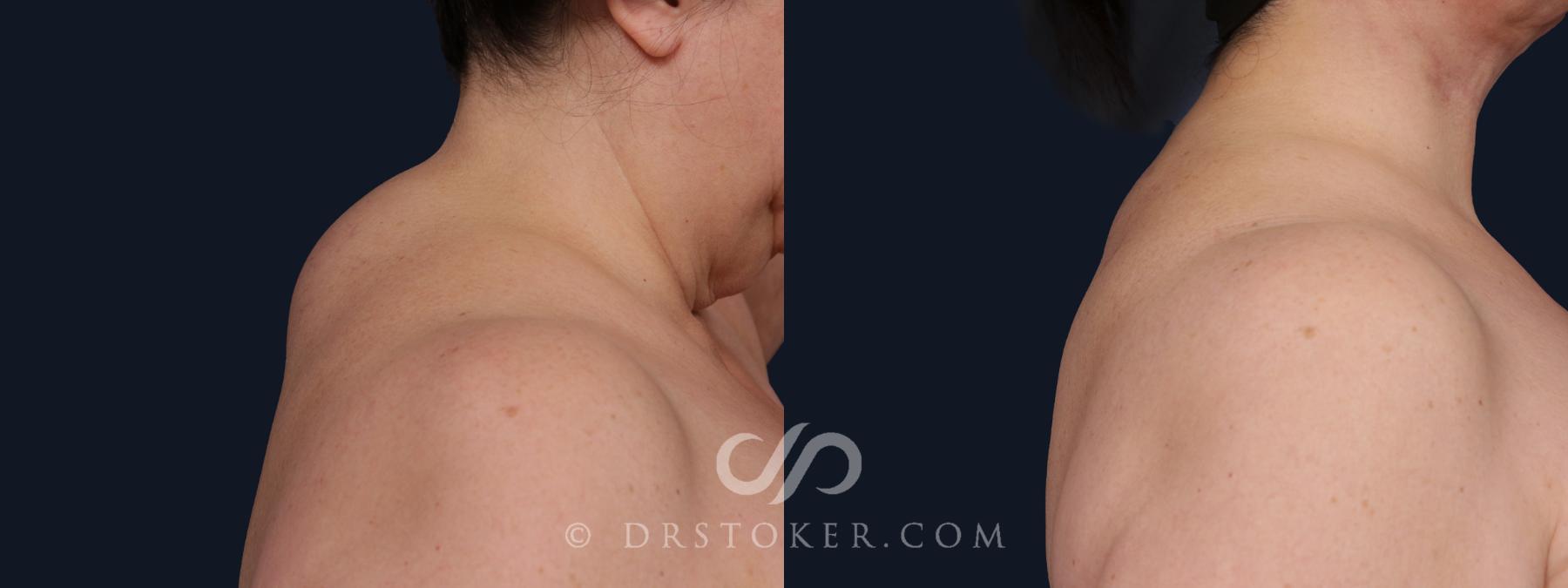 Before & After Buffalo Hump Removal  Case 2067 Right Side View in Los Angeles, CA