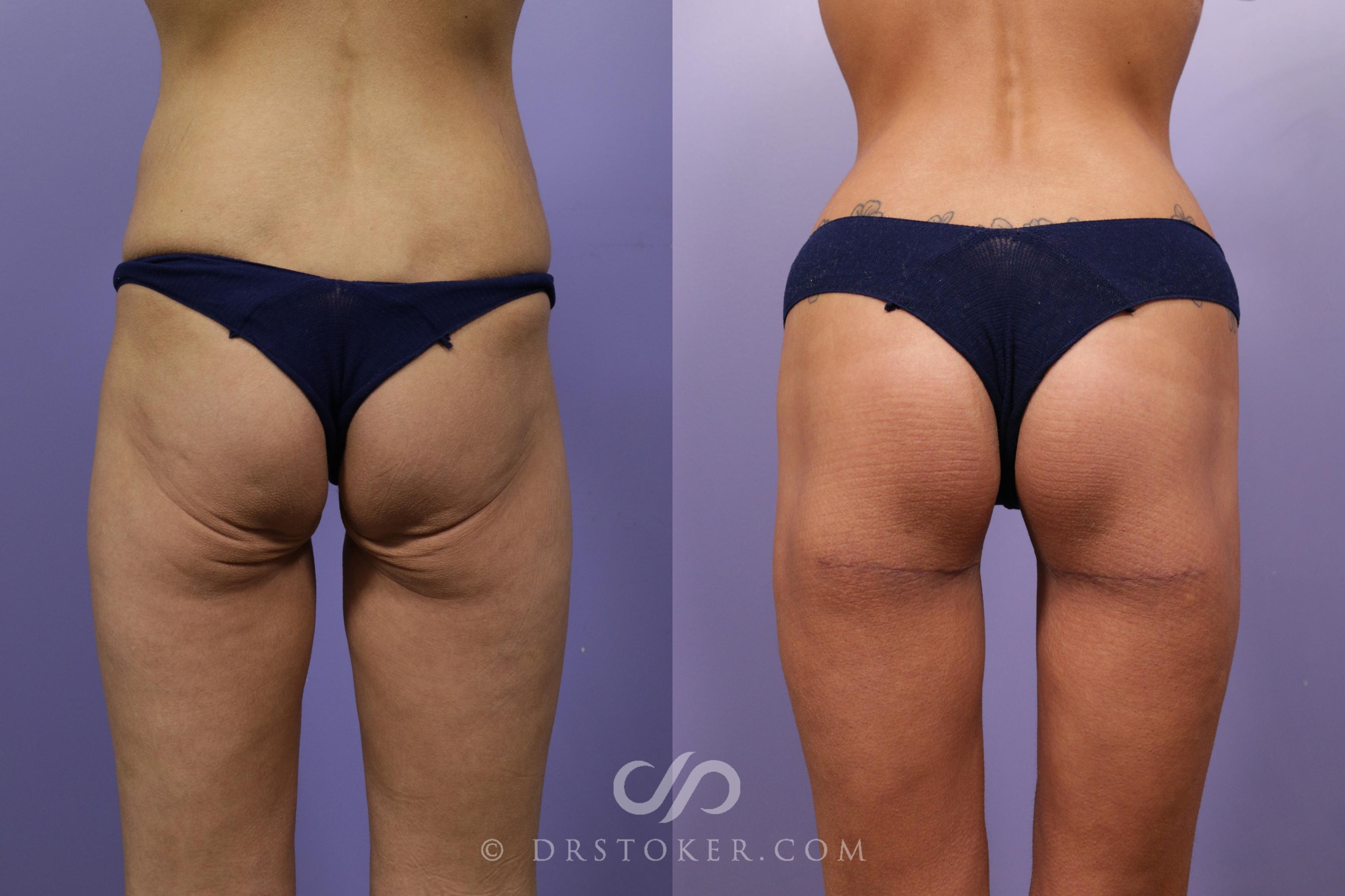 Before & After Buttock Lift (Excisional) Case 1695 View #1 View in Los Angeles, CA