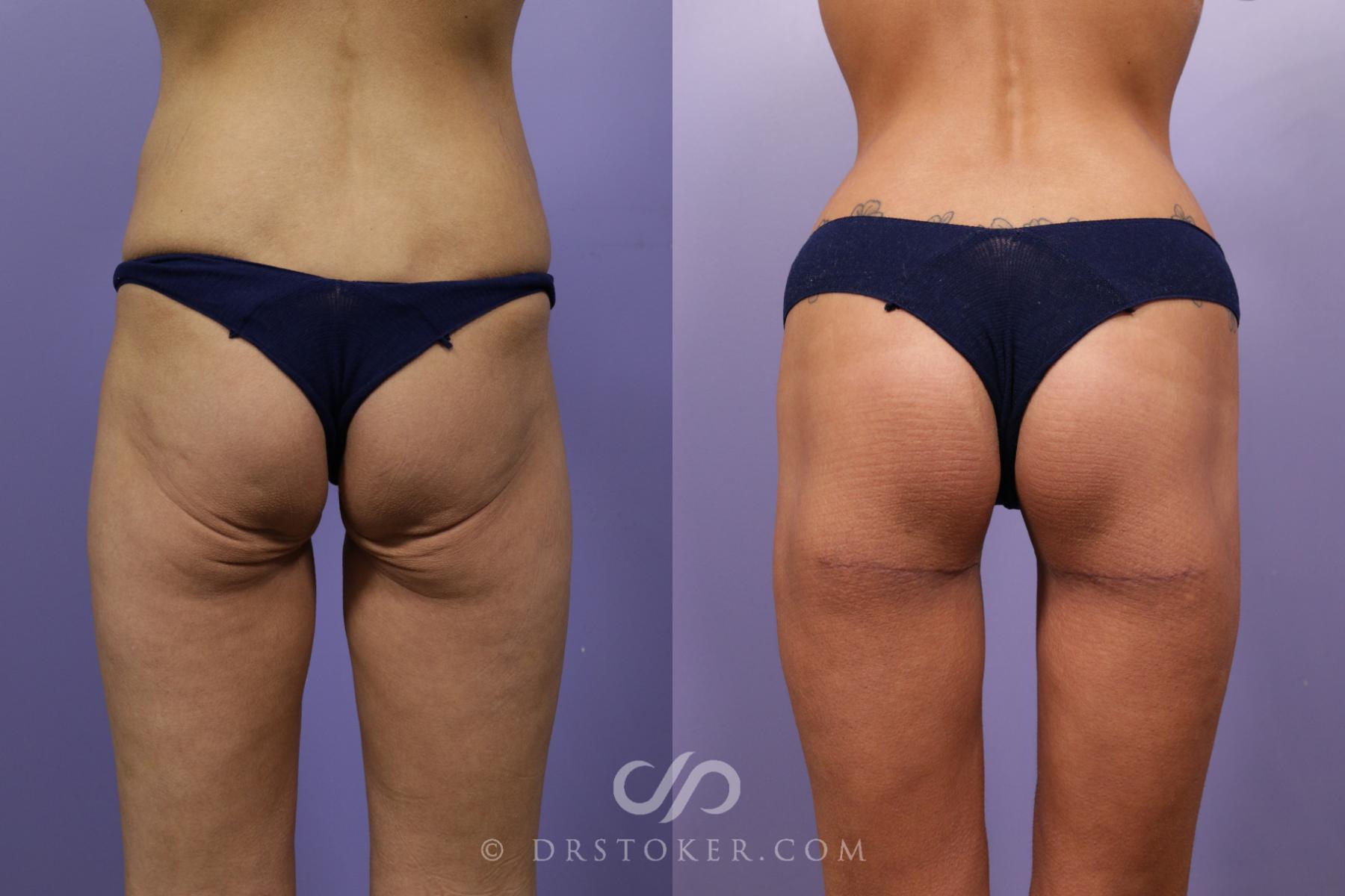 Before & After Buttock Lift (Excisional) Case 1695 View #1 View in Los Angeles, CA