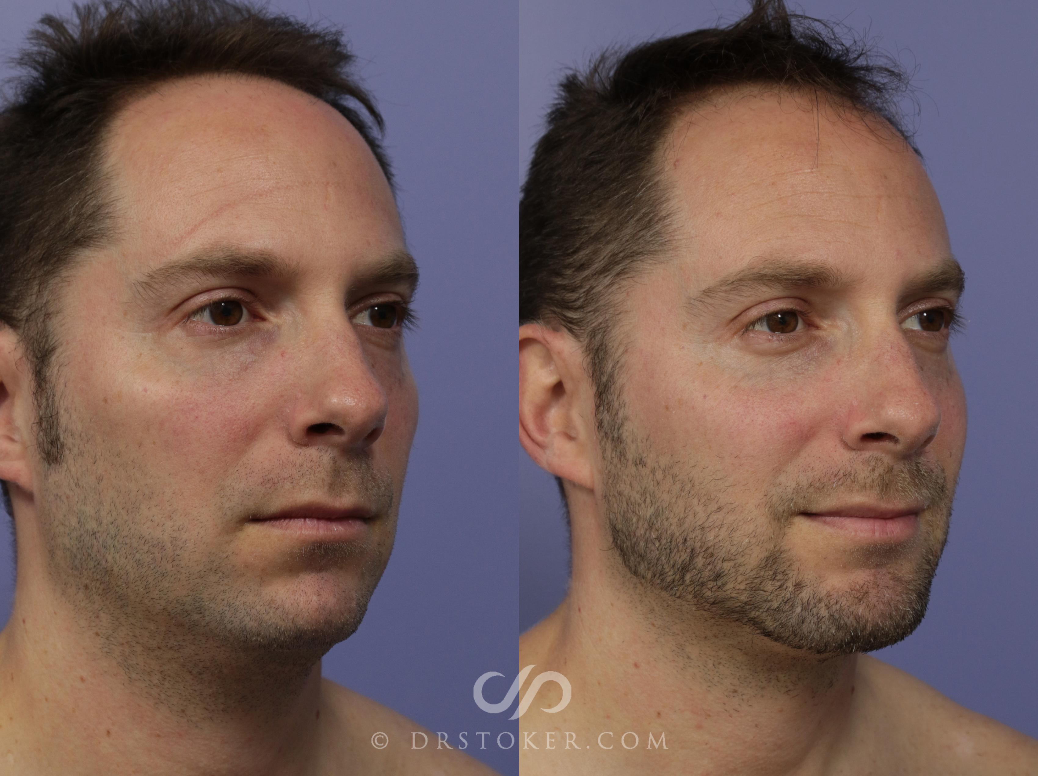 Before & After Cheek/Chin Contouring Case 1163 View #2 View in Los Angeles, CA