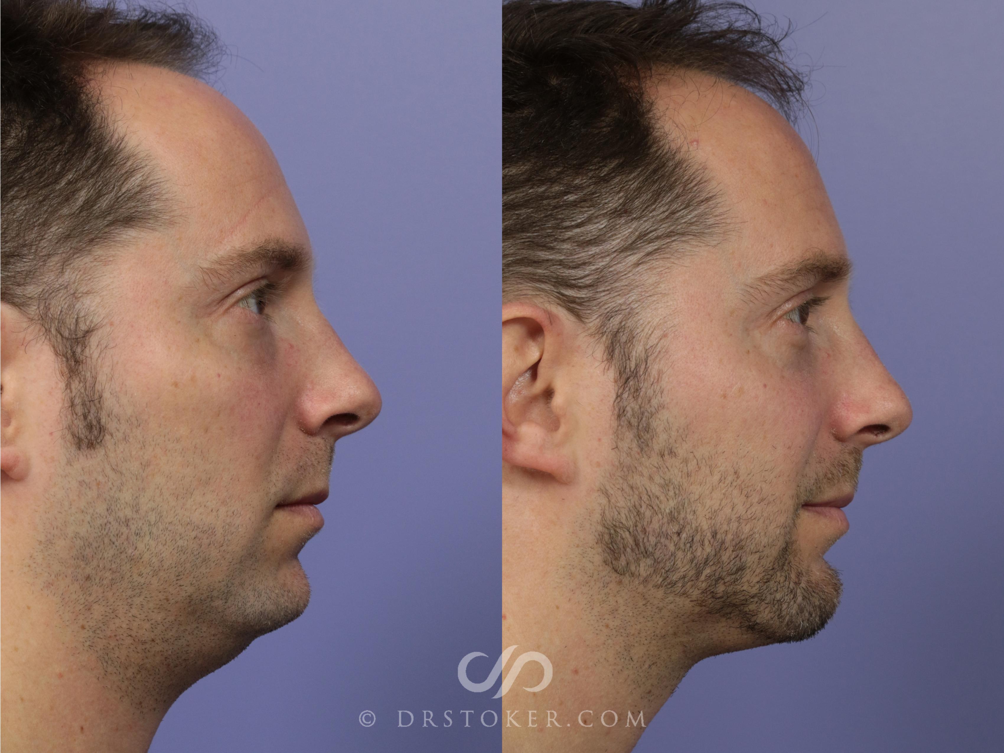 Before & After Cheek Fillers Case 1163 View #3 View in Los Angeles, CA