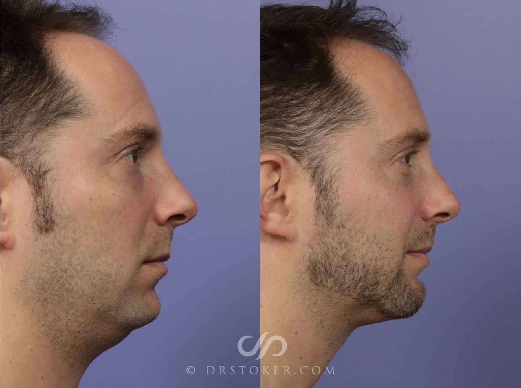Before & After Cheek Fillers Case 1163 View #3 View in Los Angeles, CA