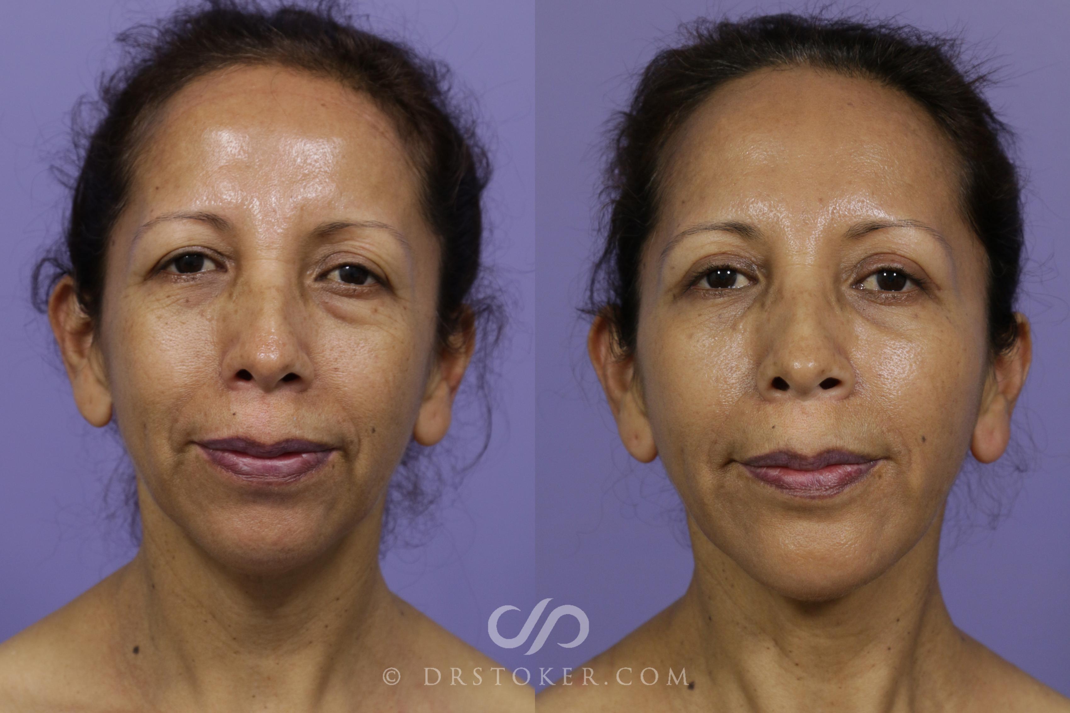 Before & After Cheek Fillers Case 1598 View #1 View in Los Angeles, CA