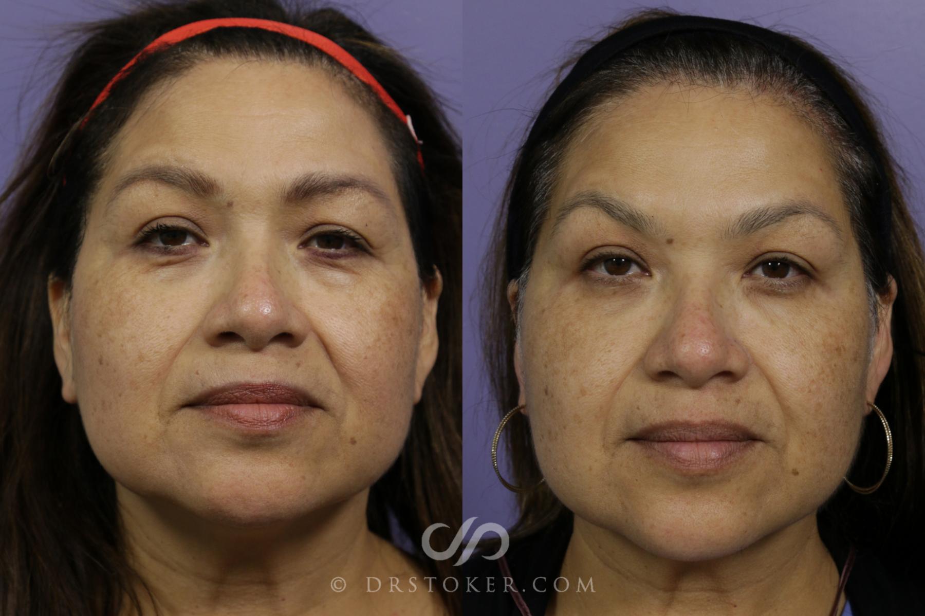 Before & After Cheek Fillers Case 1612 View #1 View in Los Angeles, CA