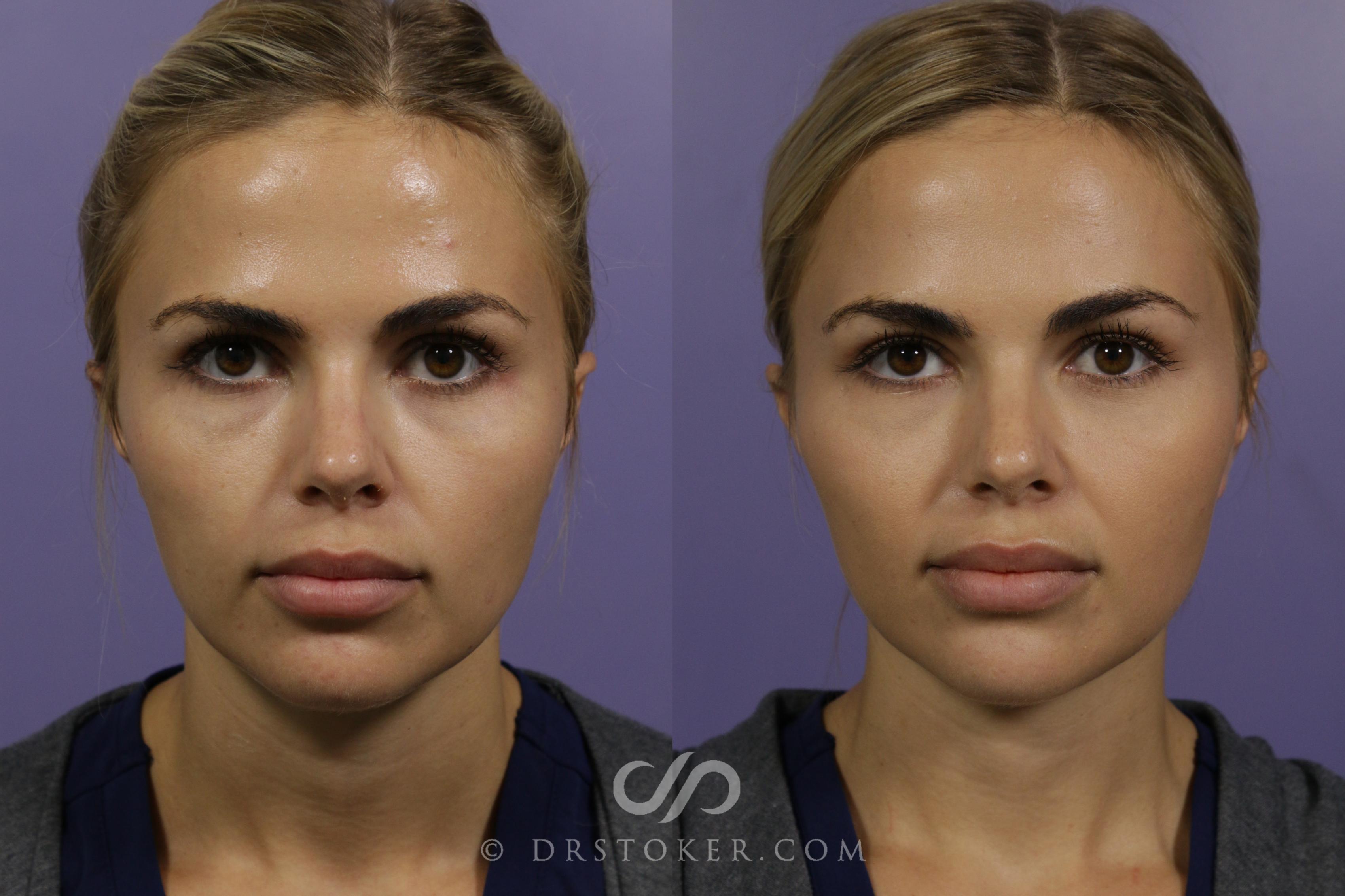 Before & After Cheek Fillers Case 1618 View #1 View in Los Angeles, CA
