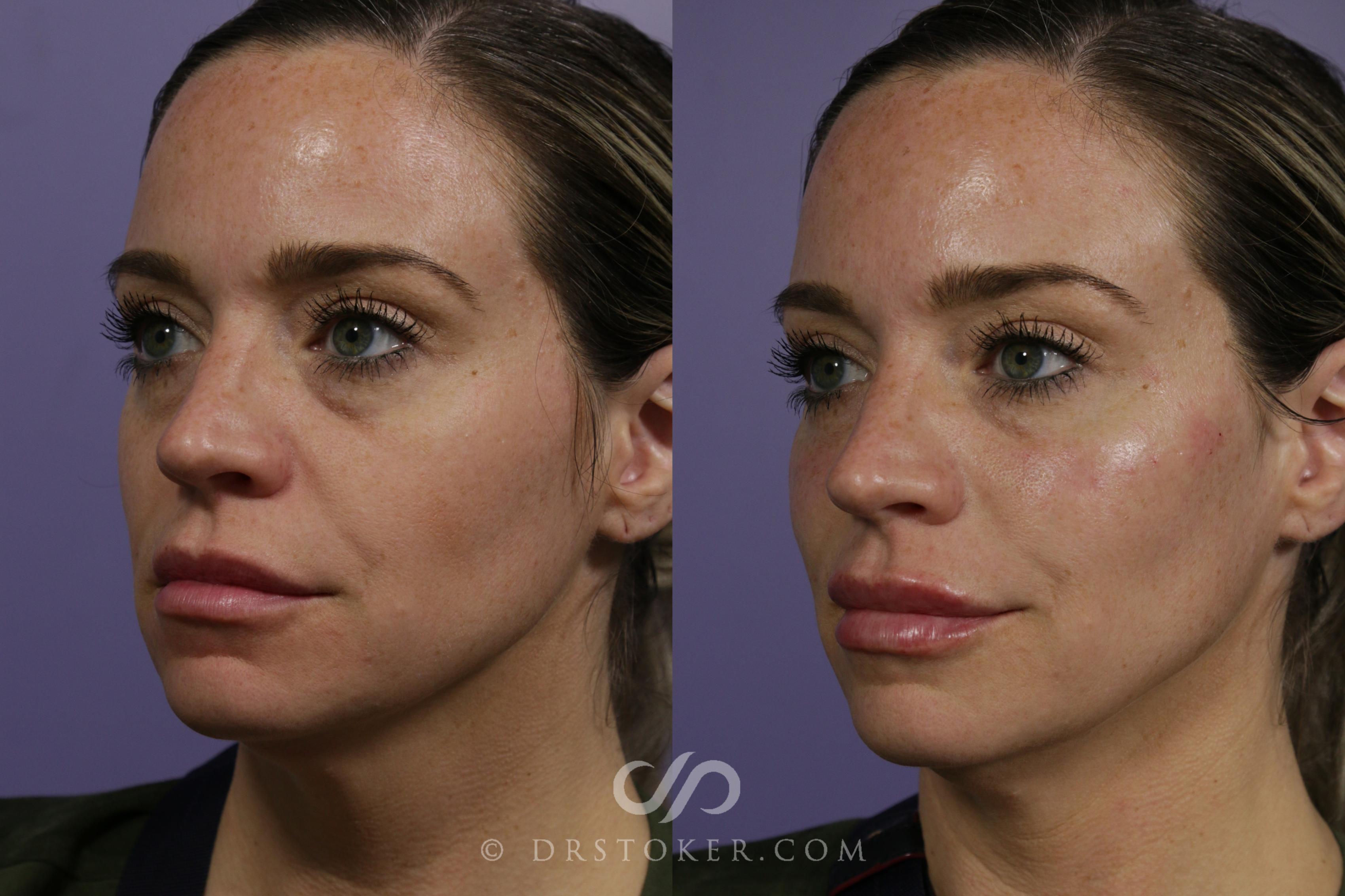 Before & After Facial Fillers Case 1622 View #1 View in Los Angeles, CA