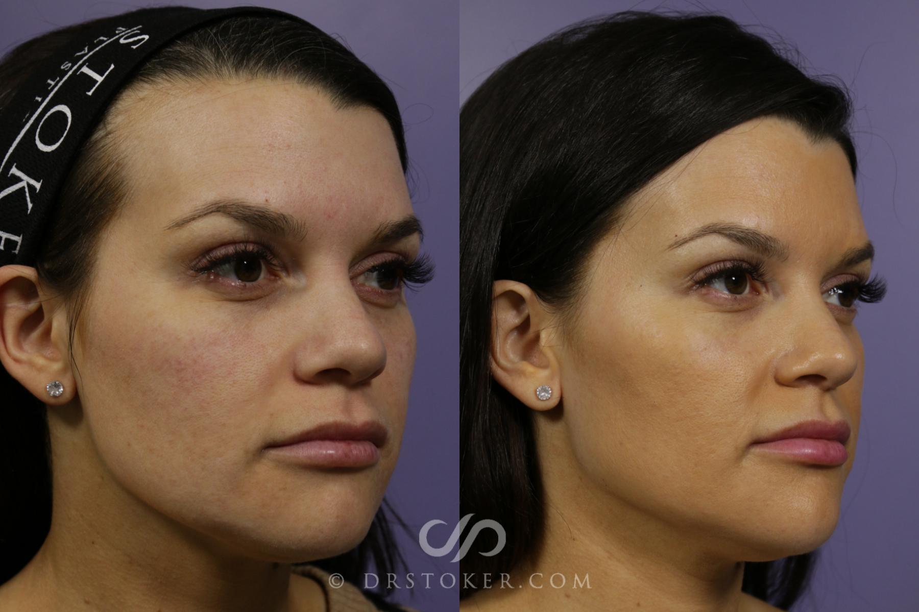Before & After Cheek Fillers Case 1645 View #1 View in Los Angeles, CA