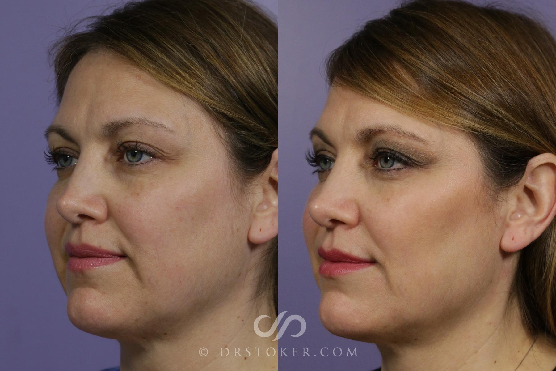 Before & After Cheek Fillers Case 1650 View #1 View in Los Angeles, CA