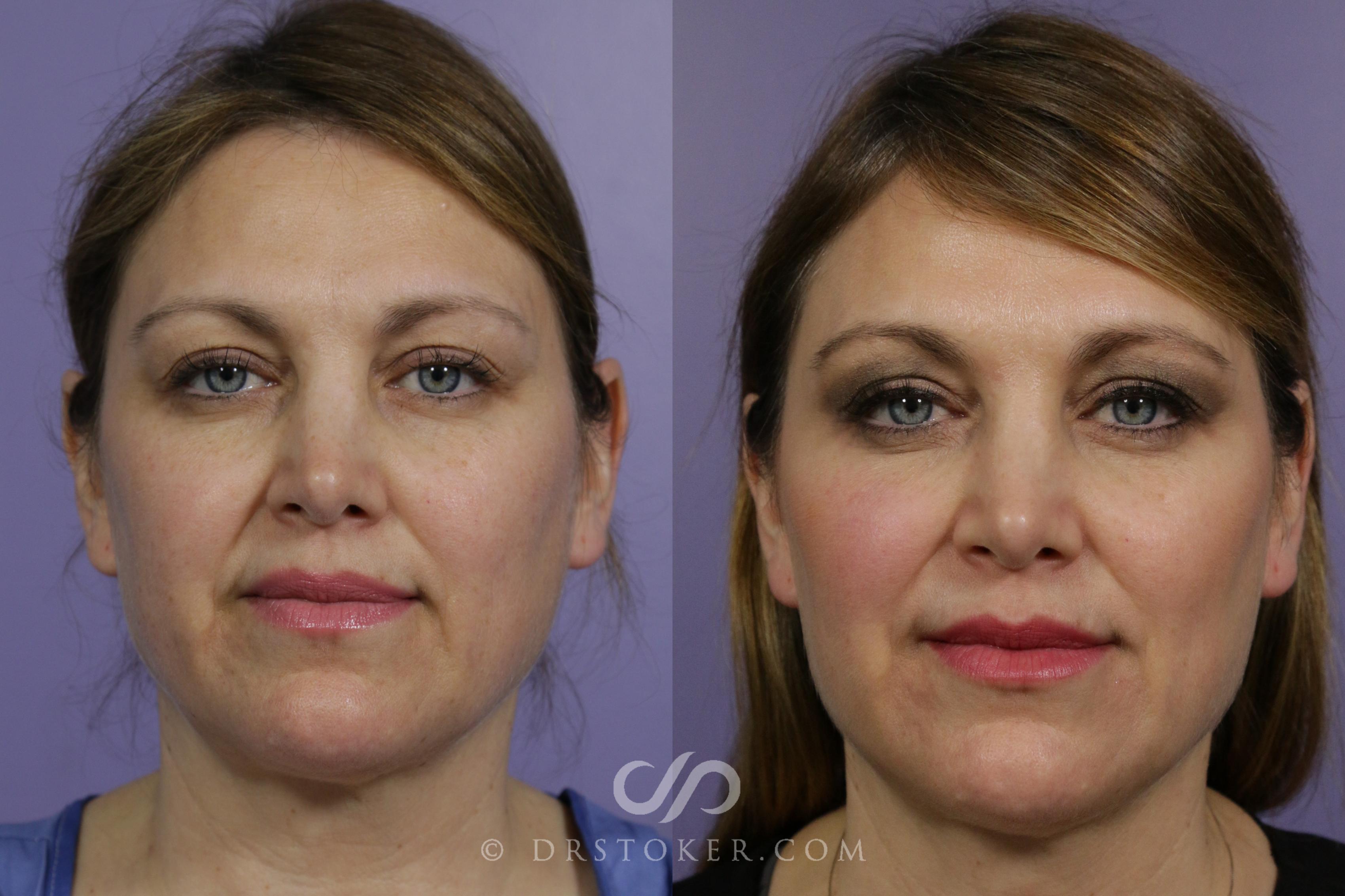 Before & After Lip Fillers/Augmentation Case 1651 View #1 View in Los Angeles, CA