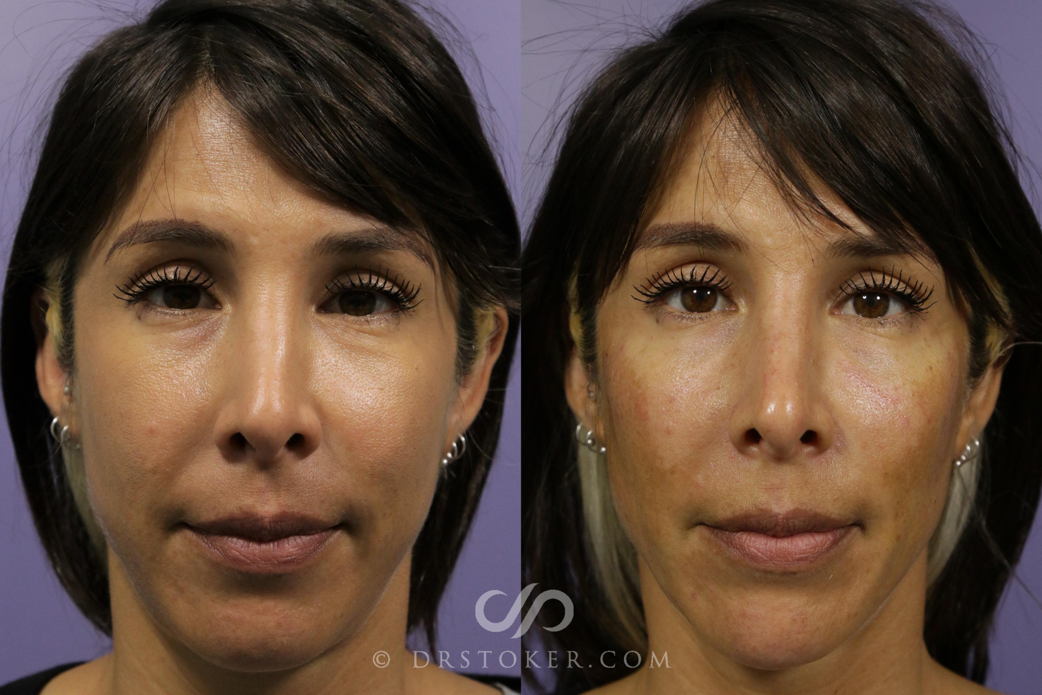 Before & After Cheek Fillers Case 1859 Front View in Los Angeles, CA