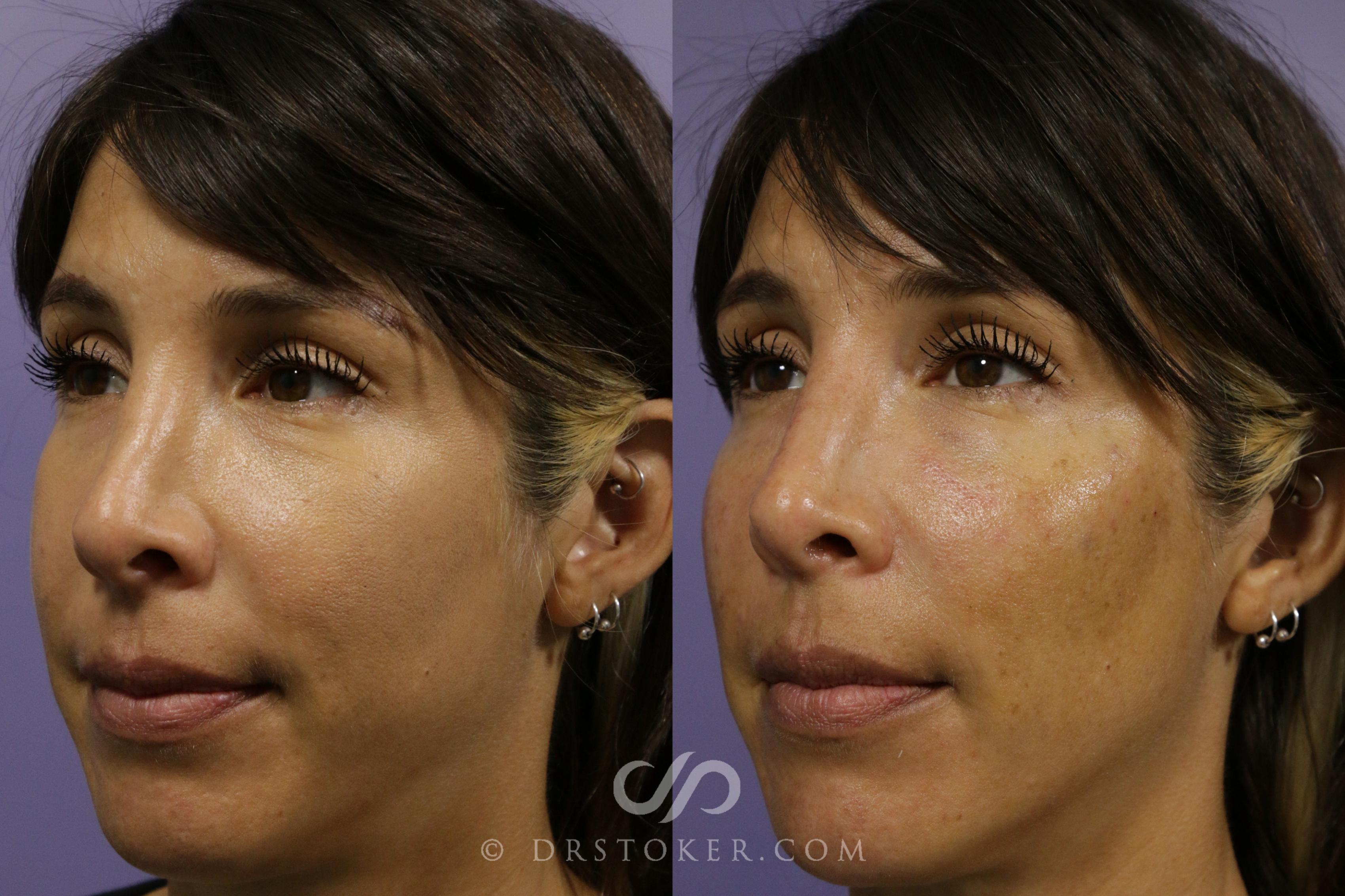 Before & After Cheek Fillers Case 1860 Left Oblique View in Los Angeles, CA